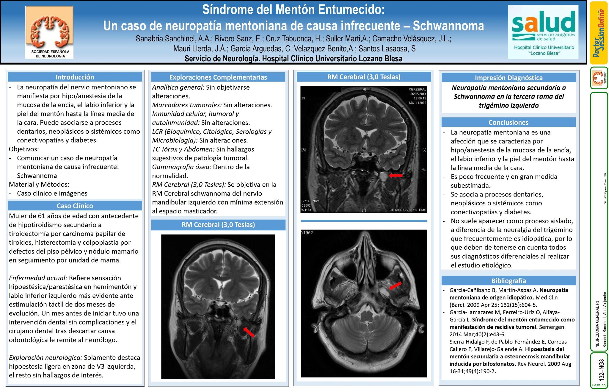 Síndrome del Mentón Entumecido: Un caso de neuropatía mentoniana de causa infrecuente - Schwanoma