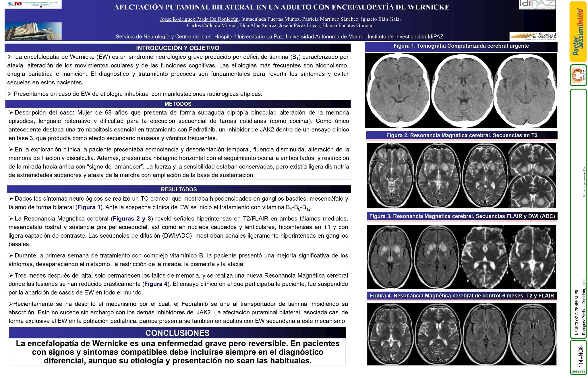 Encefalopatía de Wernicke con afectación putaminal bilateral: a propósito de un caso.