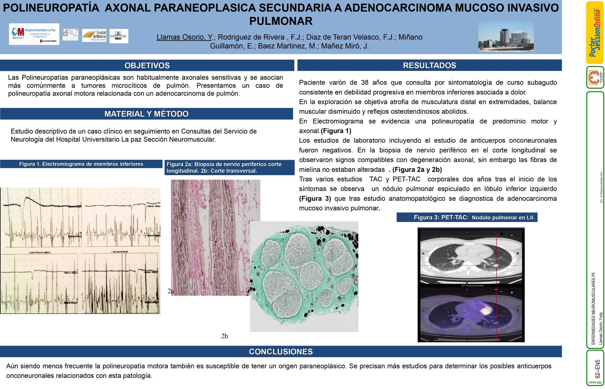 Polineuropatía axonal paraneoplasica secundaria a adenocarcinoma mucoso invasivo pulmonar