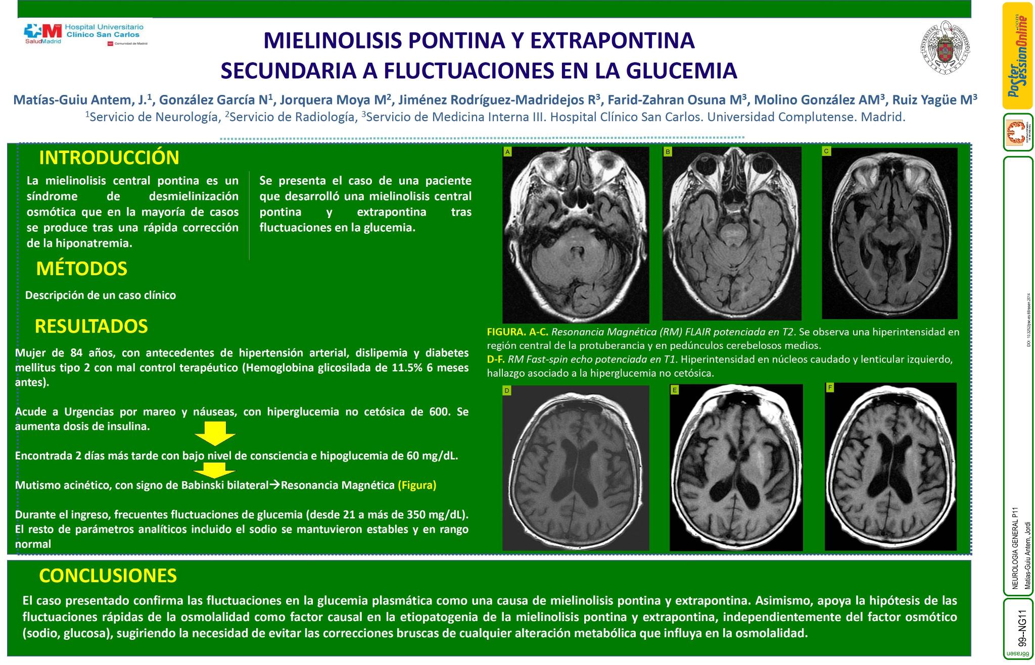 Mielinolisis pontina y extrapontina secundaria a fluctuaciones en la glucemia