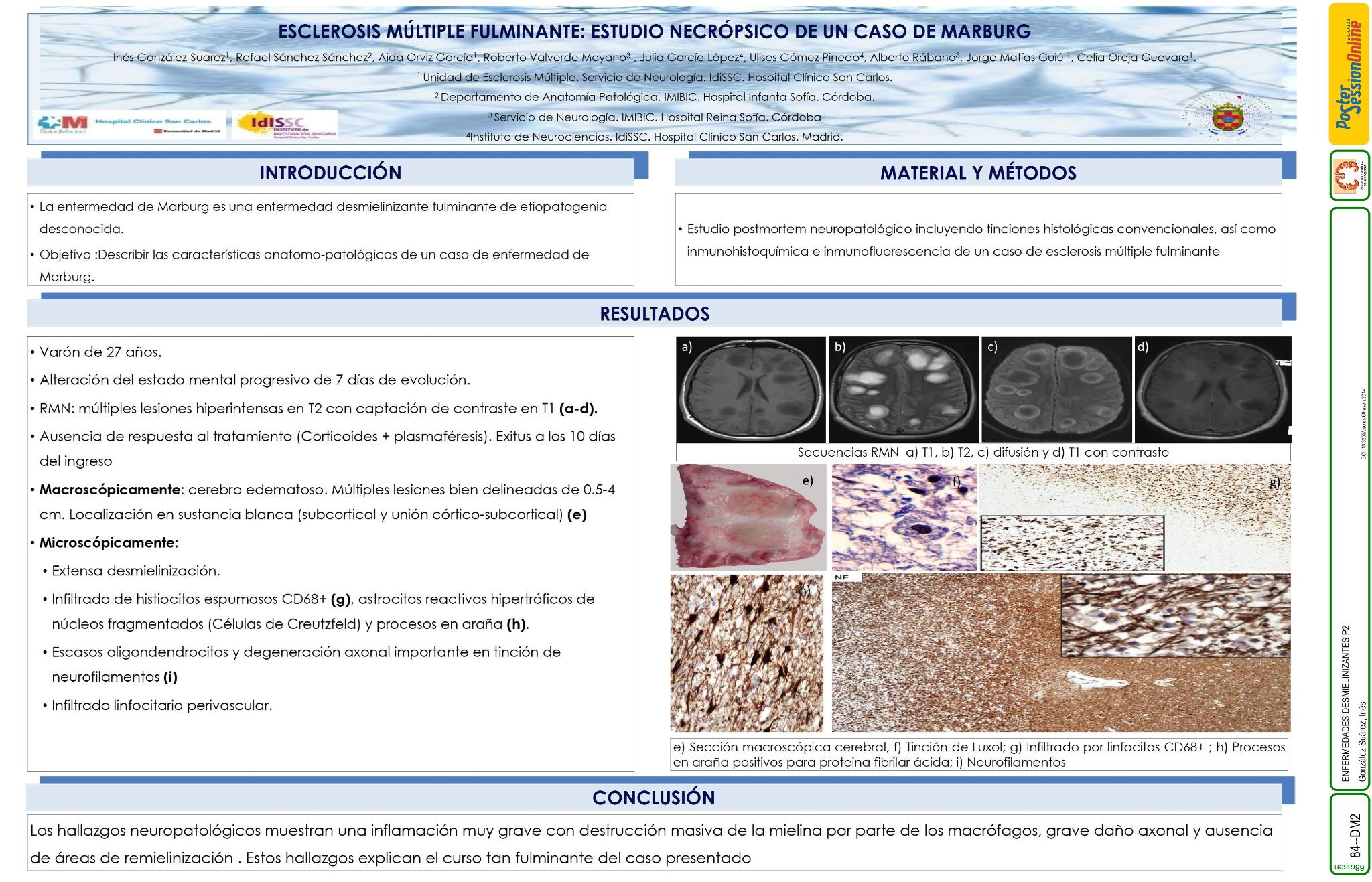 Esclerosis múltiple fulminante: estudio necrópsico de un caso de Marburg