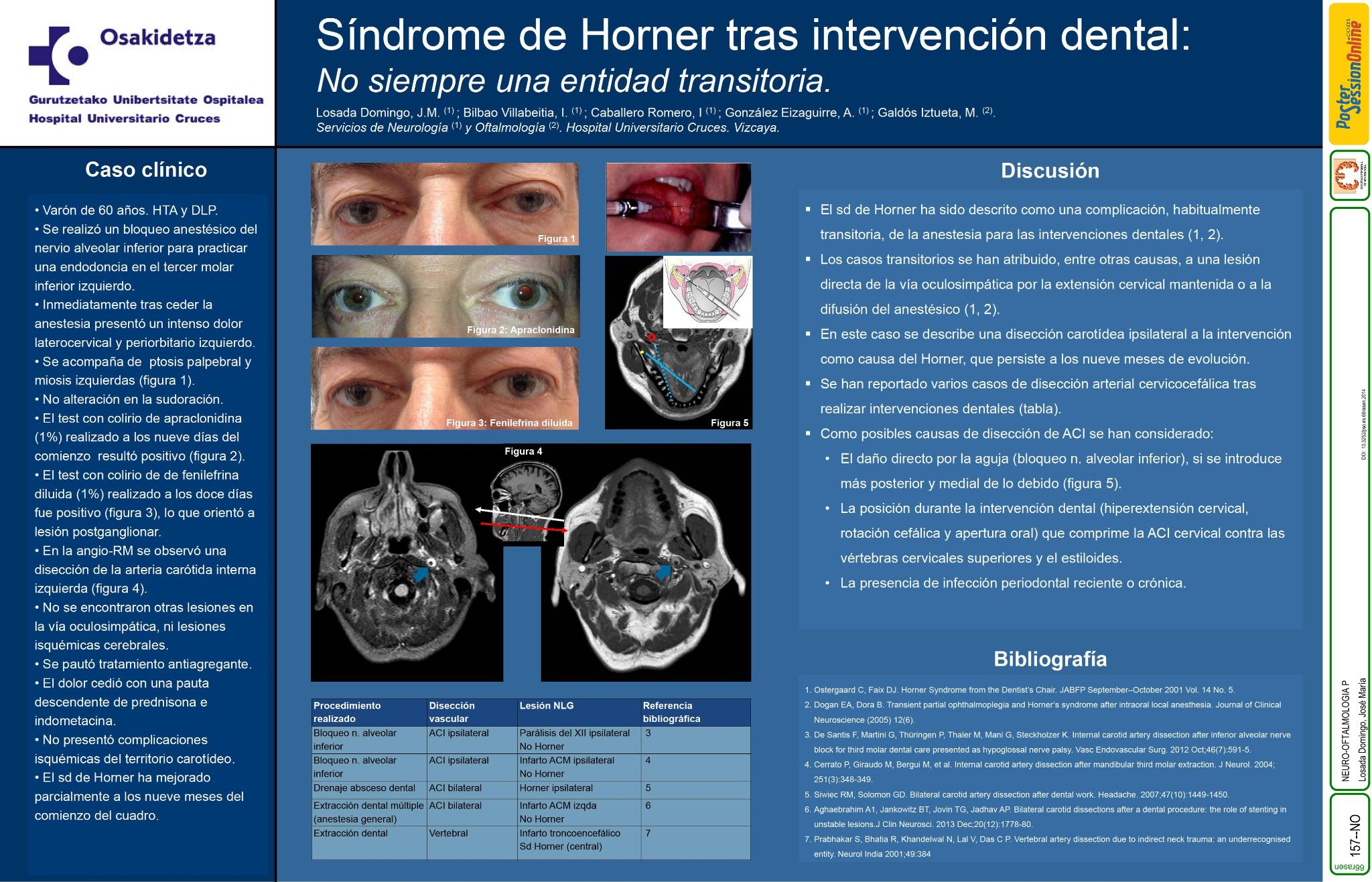 Síndrome de Horner tras intervención dental: no siempre una entidad transitoria