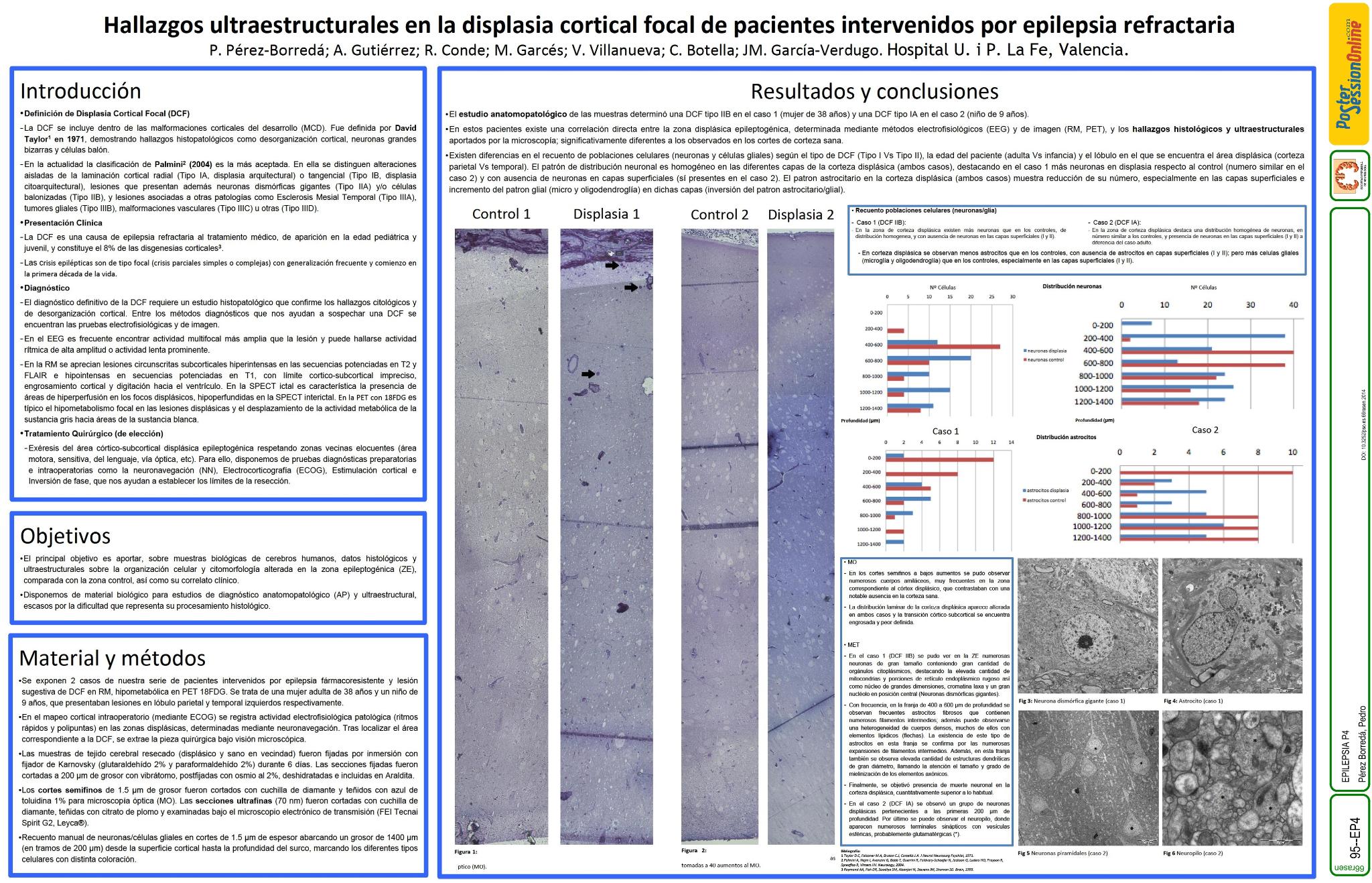 Hallazgos ultraestructurales de displasia cortical focal en una paciente intervenida por epilepsia refractaria