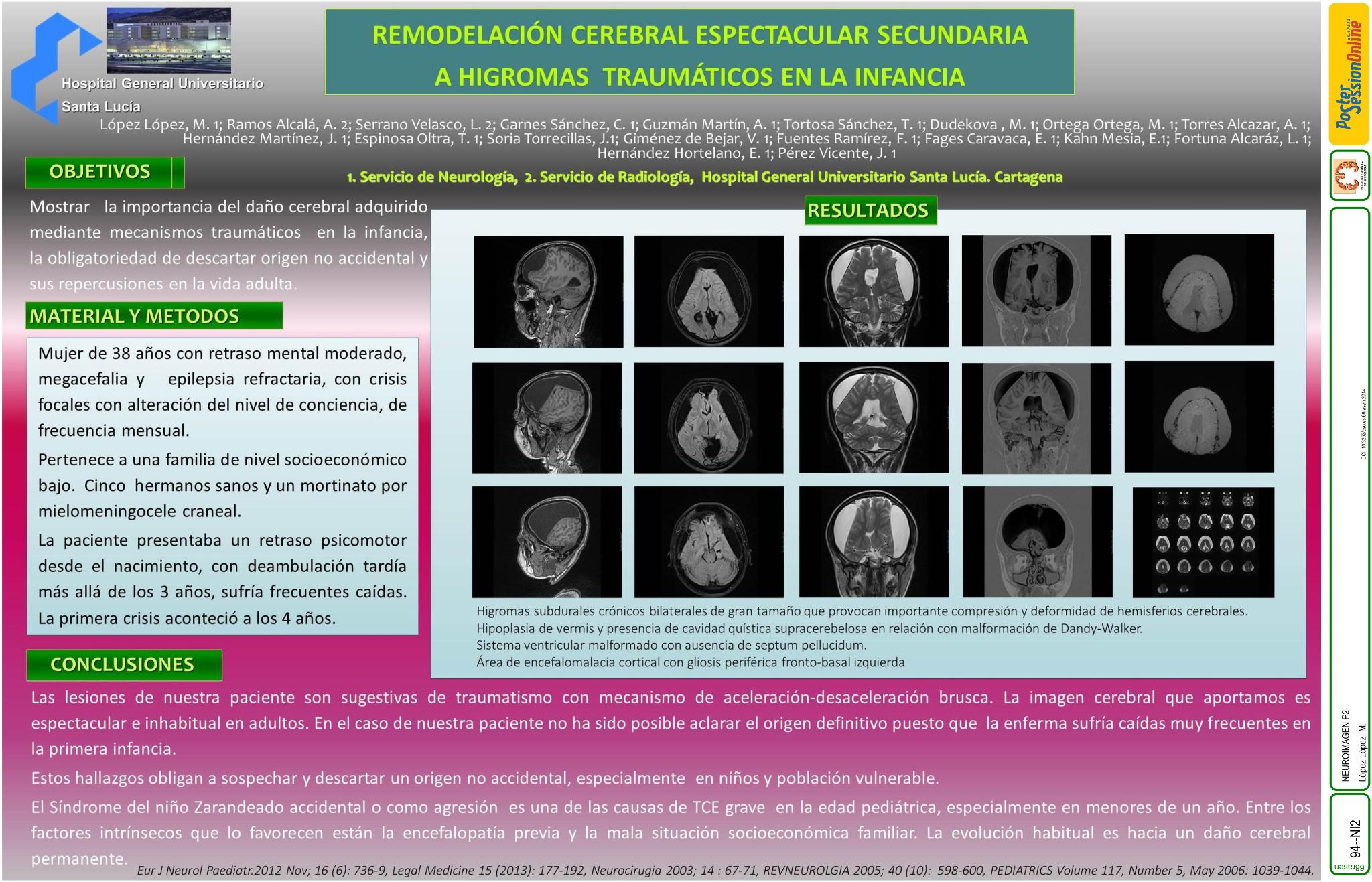 Remodelación cerebral espectacular secundaria a higromas