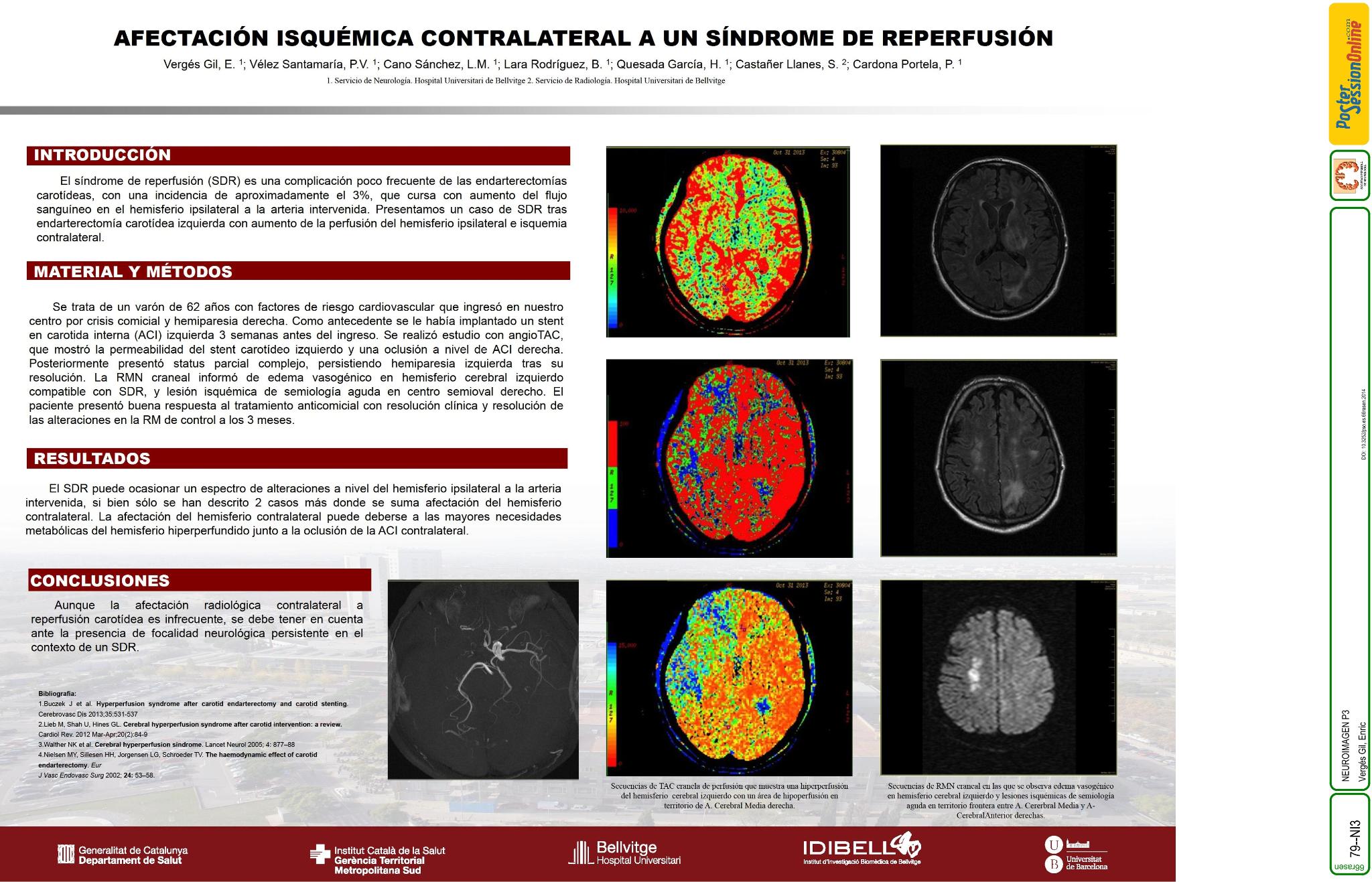 Afectación isquémica contralateral a un síndrome de reperfusión