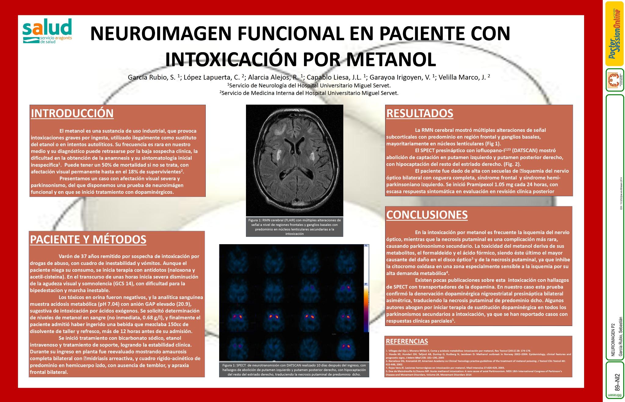 Neuroimagen funcional en paciente con intoxicación de metanol