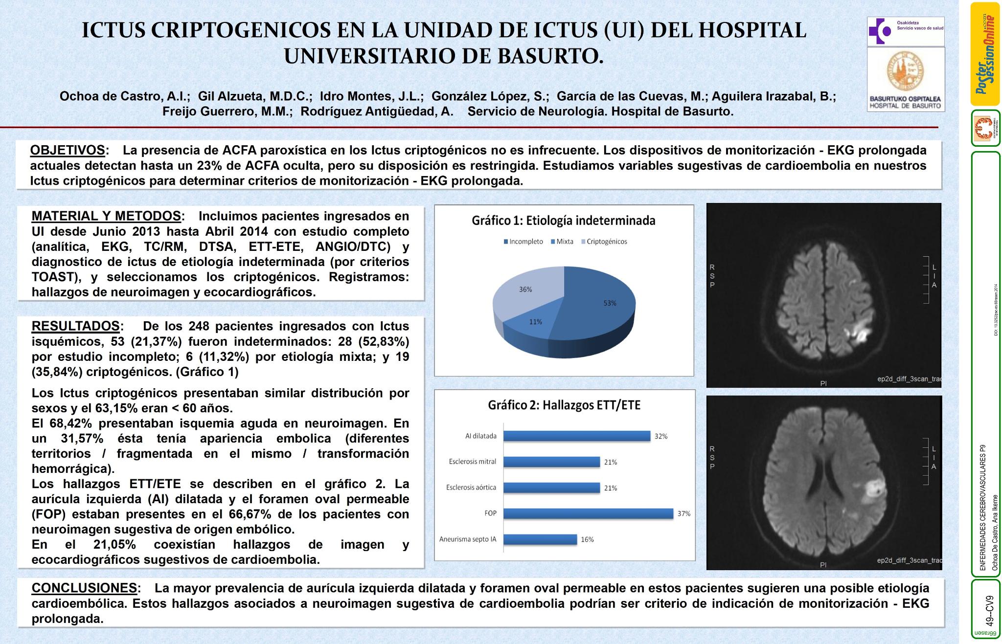 Ictus criptogenicos en la unidad de ictus (UI) del hospital universitario de Basurto