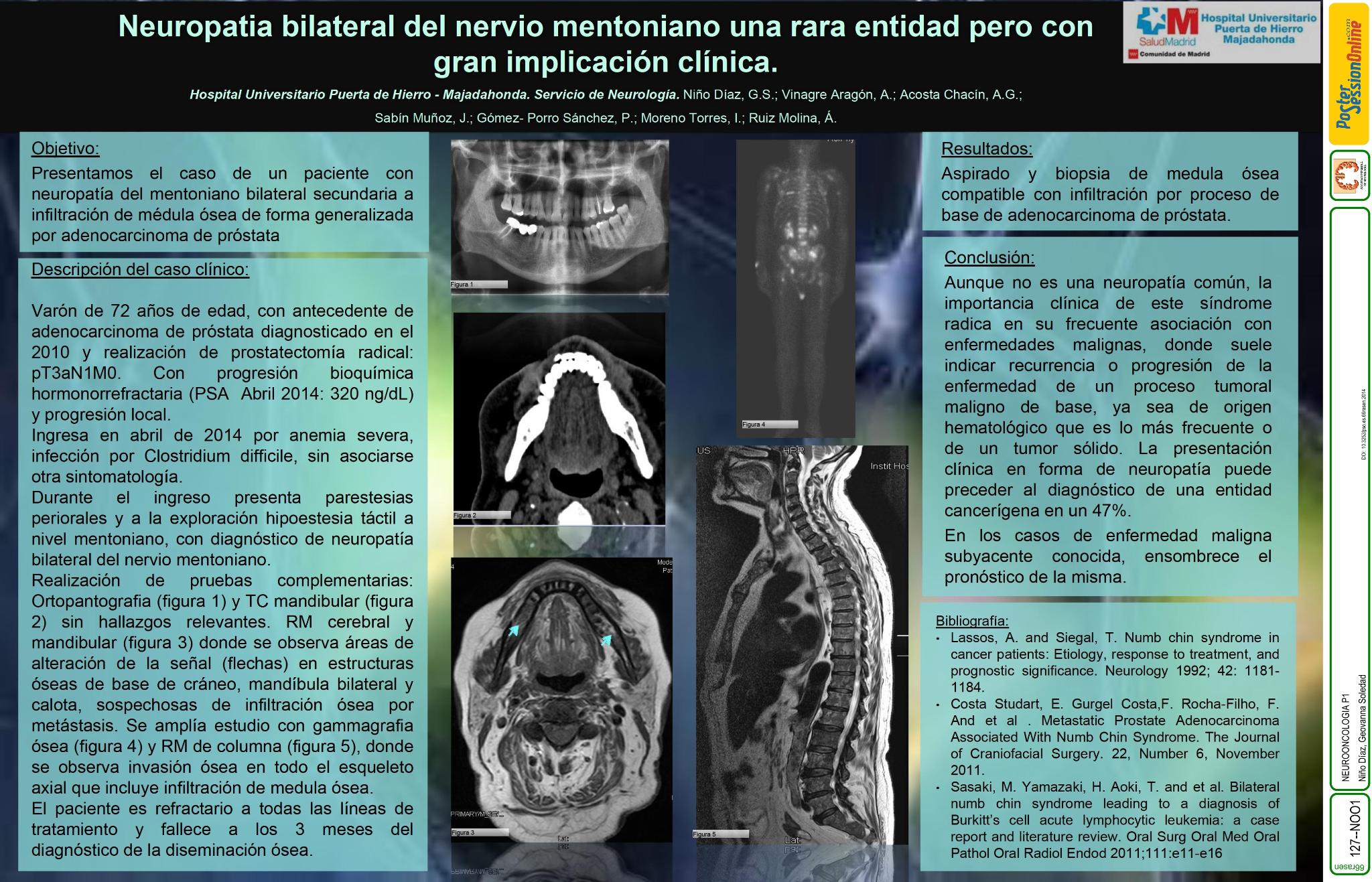 Neuropatia bilateral del nervio mentoniano una rara entidad pero con gran implicación clínica