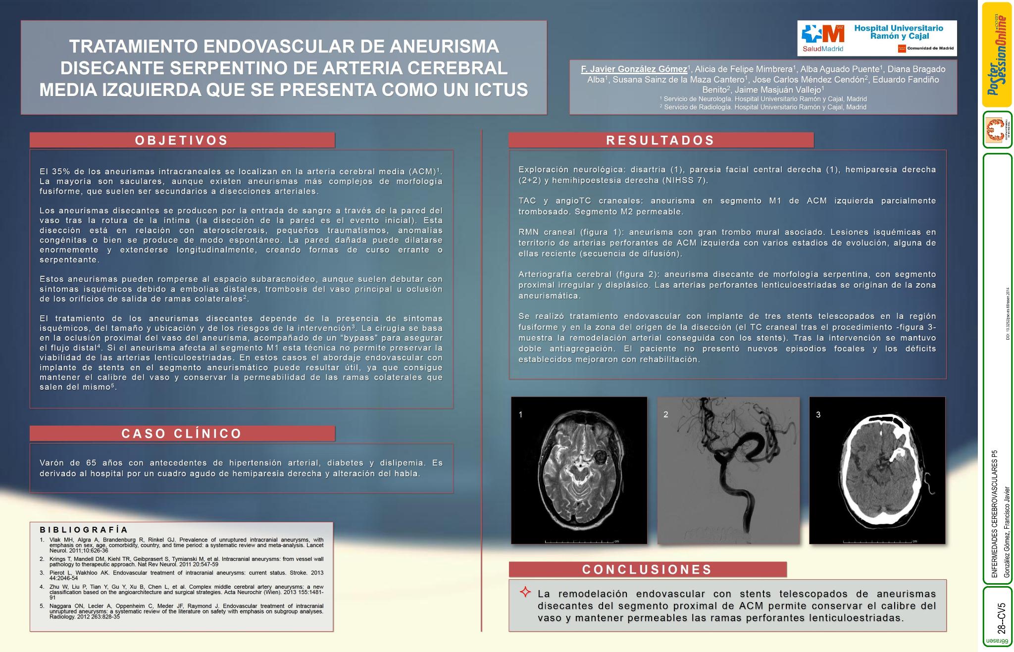 Tratamiento endovascular de aneurisma disecante serpentino de arteria cerebral media izquierda que se presenta como un ictus