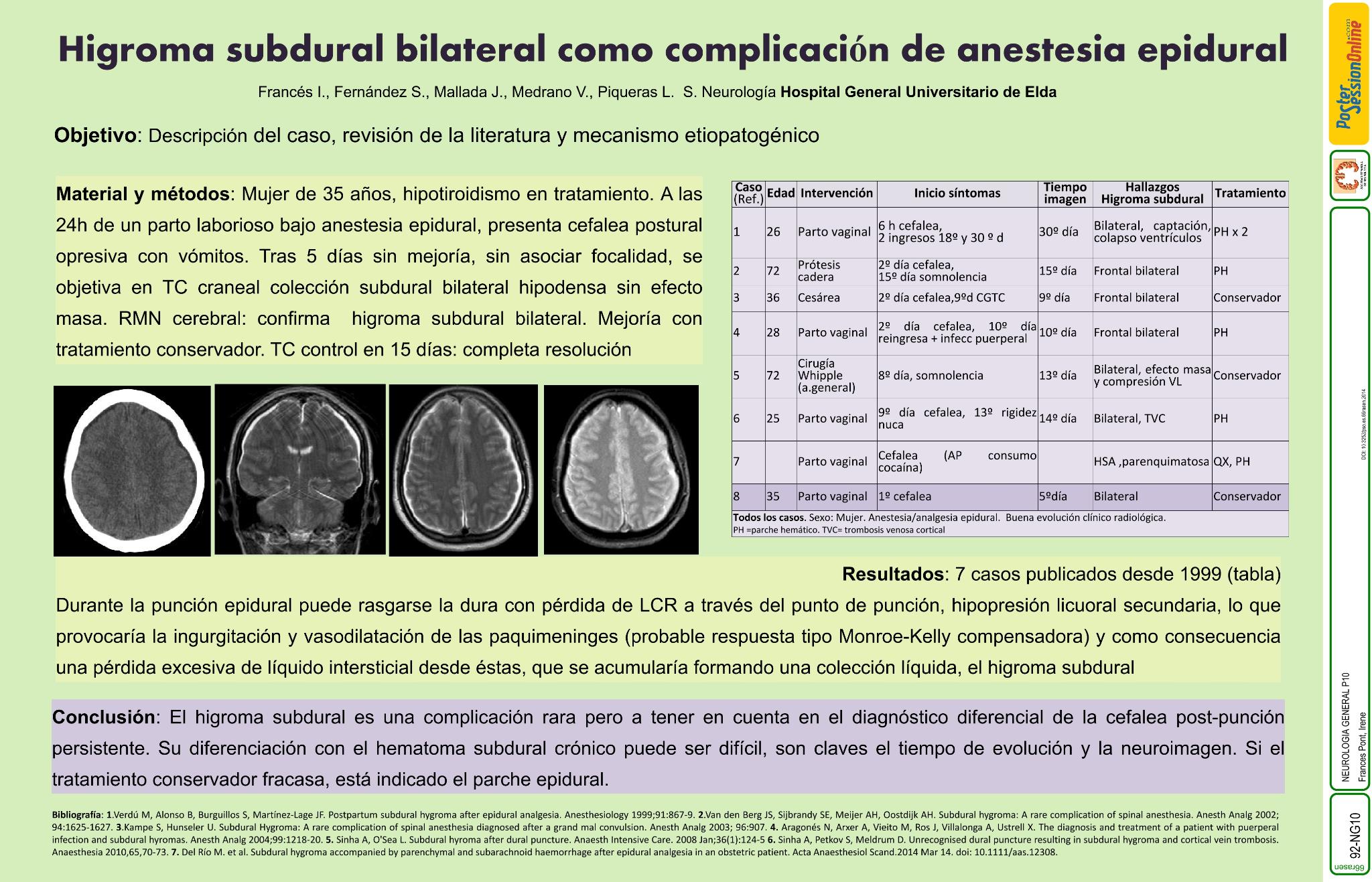 Higroma subdural bilateral como complicación de anestesia epidural