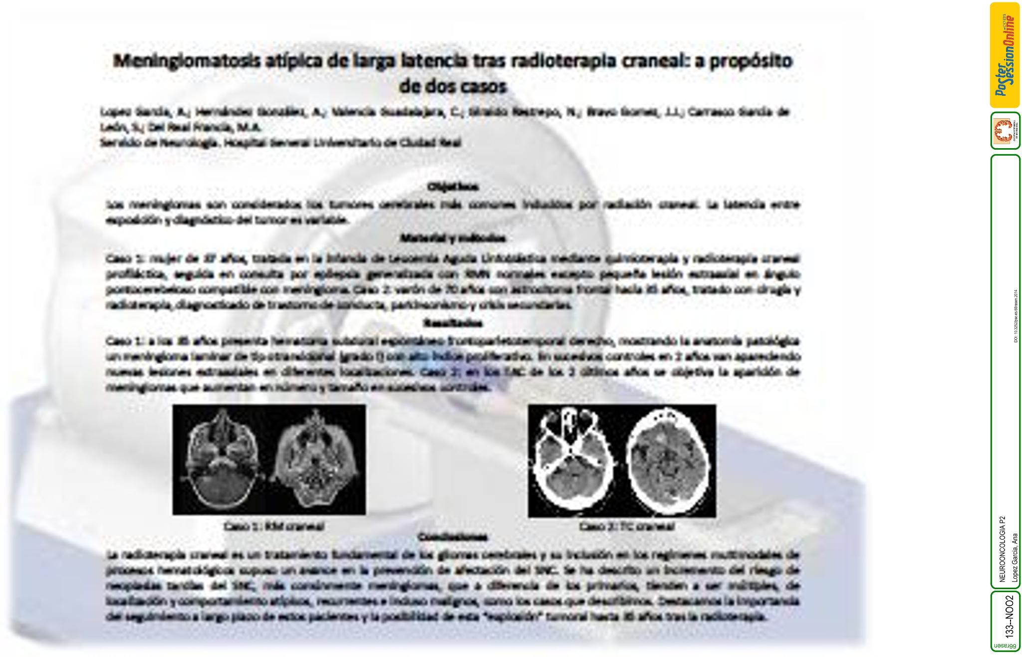Meningiomatosis atípica de larga latencia tras radioterapia craneal: a propósito de dos casos