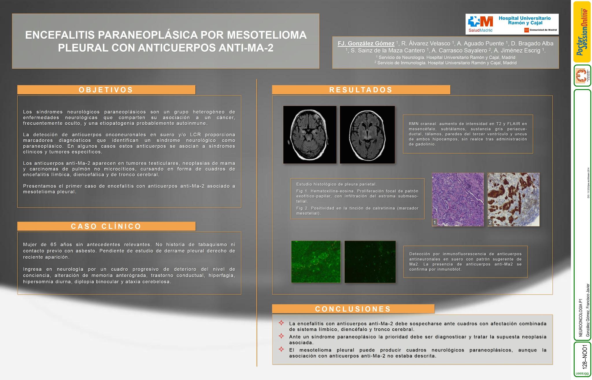 Encefalitis paraneoplásica por mesotelioma pleural con anticuerpos anti-Ma-2. Primer caso descrito