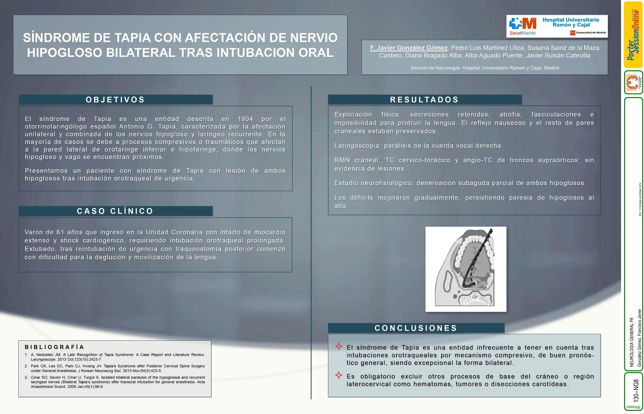 Síndrome de Tapia con afectación de nervio hipogloso bilateral tras intubación oral