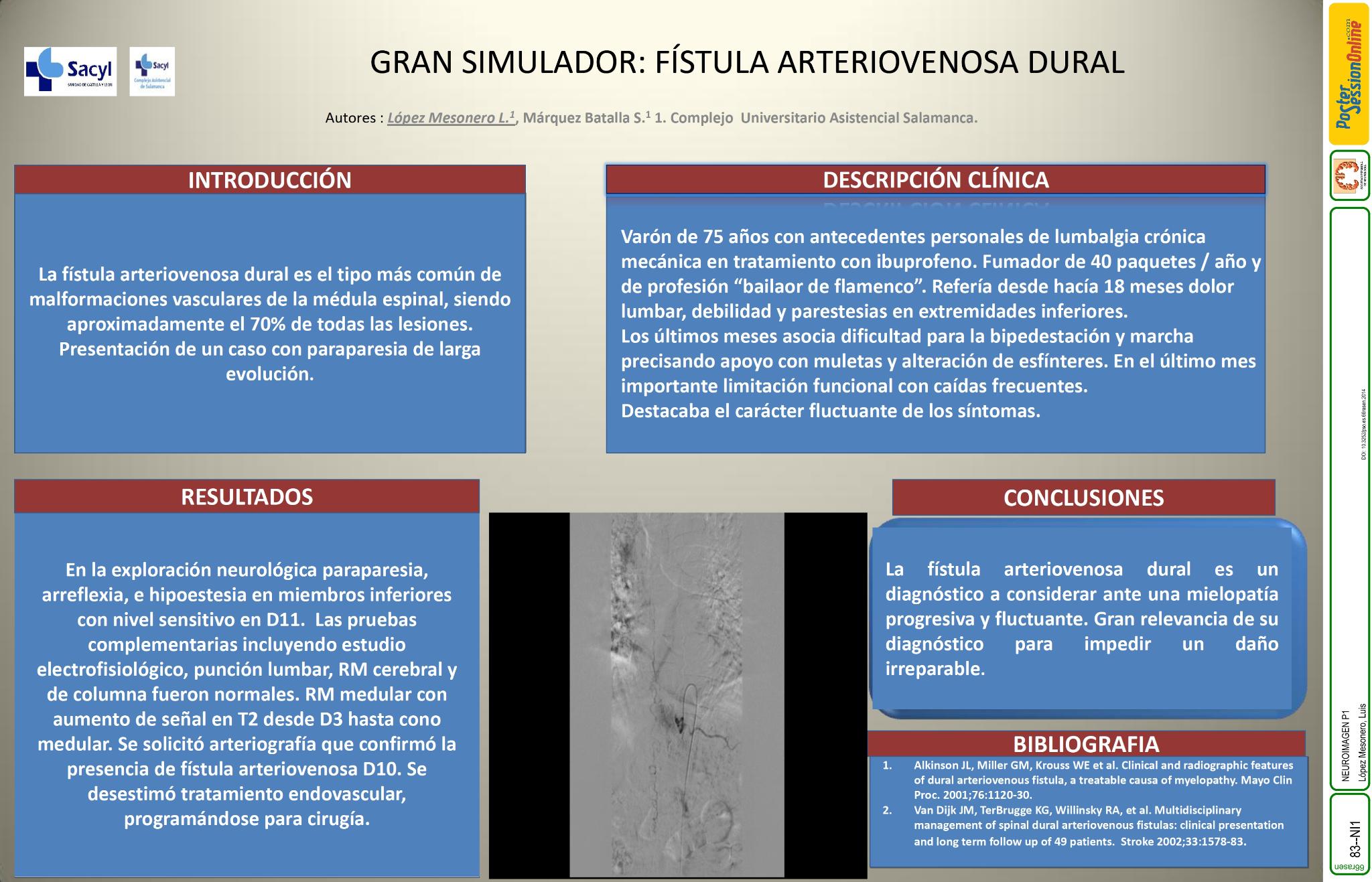 Gran simulador: fístula arteriovenosa dural