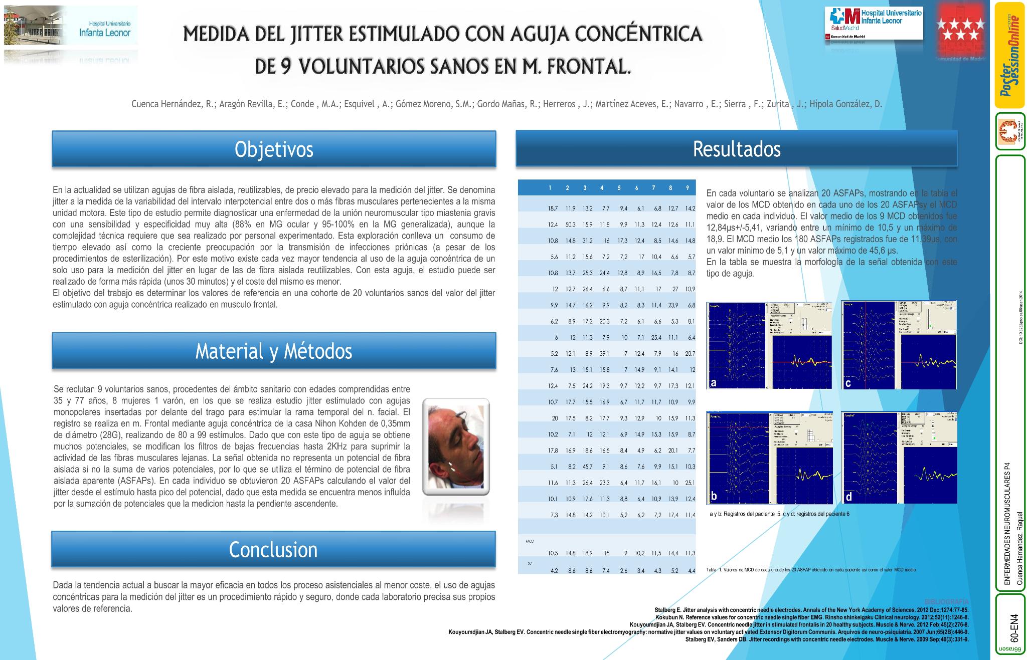 Valores del jitter estimulado con aguja concéntrica de 9 voluntarios sanos en musculo Frontal