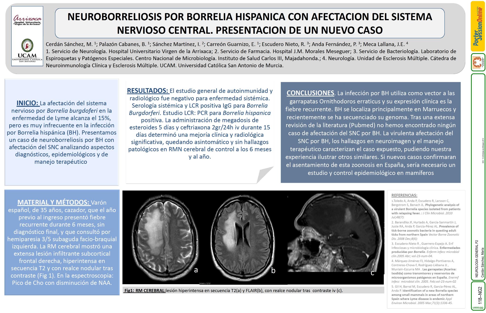 Neuroborreliosis por borrelia hispanica con afectacion del sistema nervioso central. Presentacion de un nuevo caso