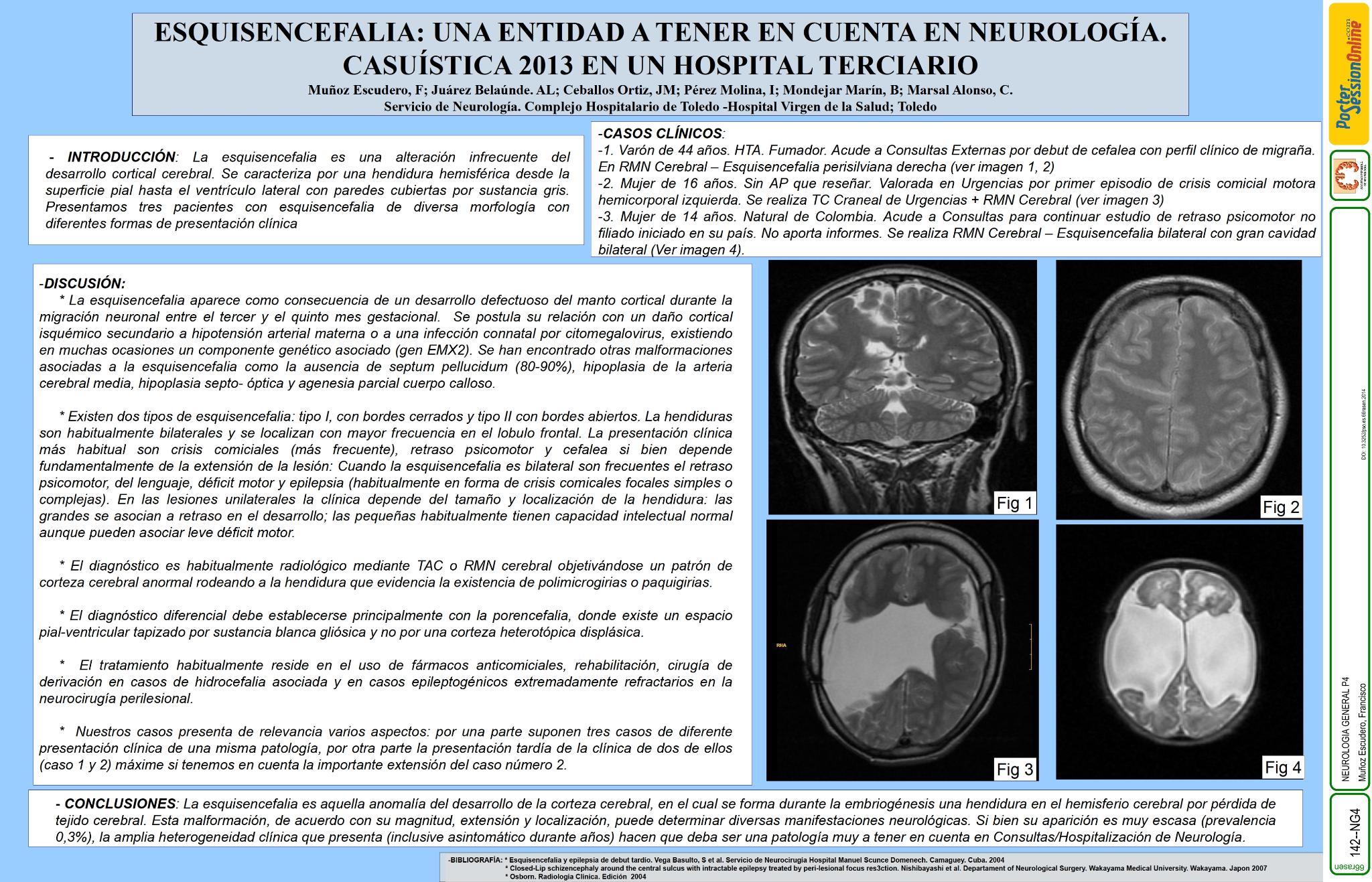 Esquisencefalia: una entidad a tener en cuenta en neurología. Casuistica 2013 en un hospital terciario