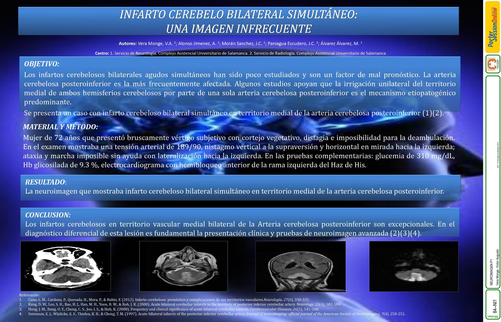 Infarto cerebelo bilateral simultáneo: Una imagen infrecuente