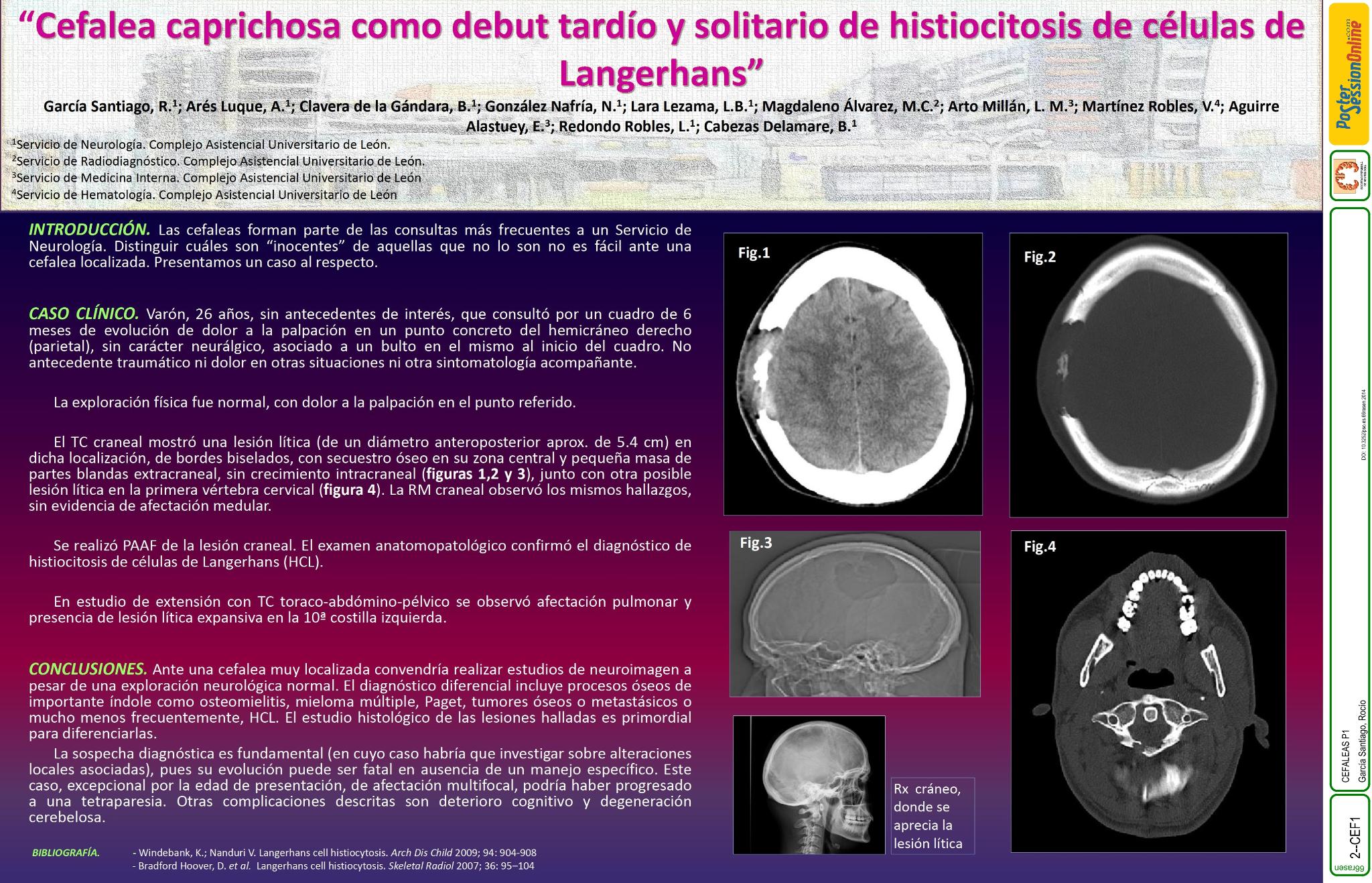 Cefalea caprichosa como debut tardío y solitario de histiocitosis de células de Langerhans