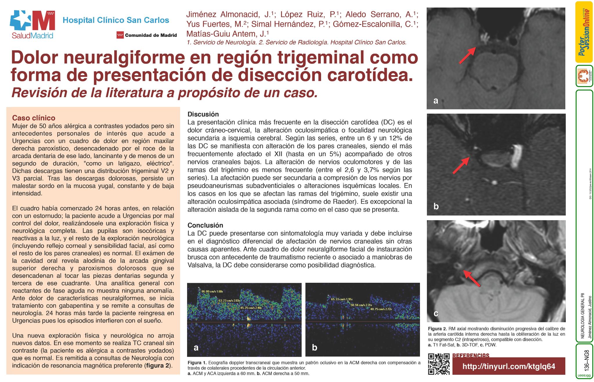 Dolor neuralgiforme en región trigeminal como forma de presentación de disección carotídea: revisión de la literatura a propósito de un caso
