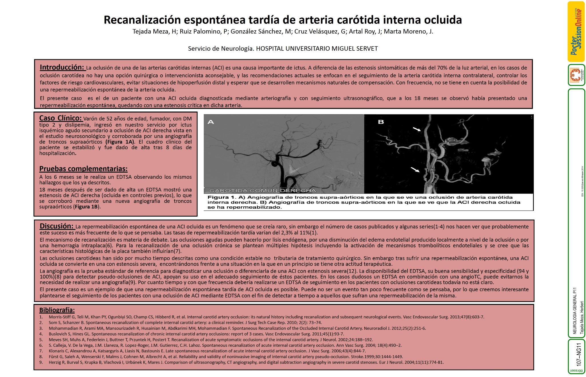 Recanalización espontánea tardía de arteria carótida interna ocluida