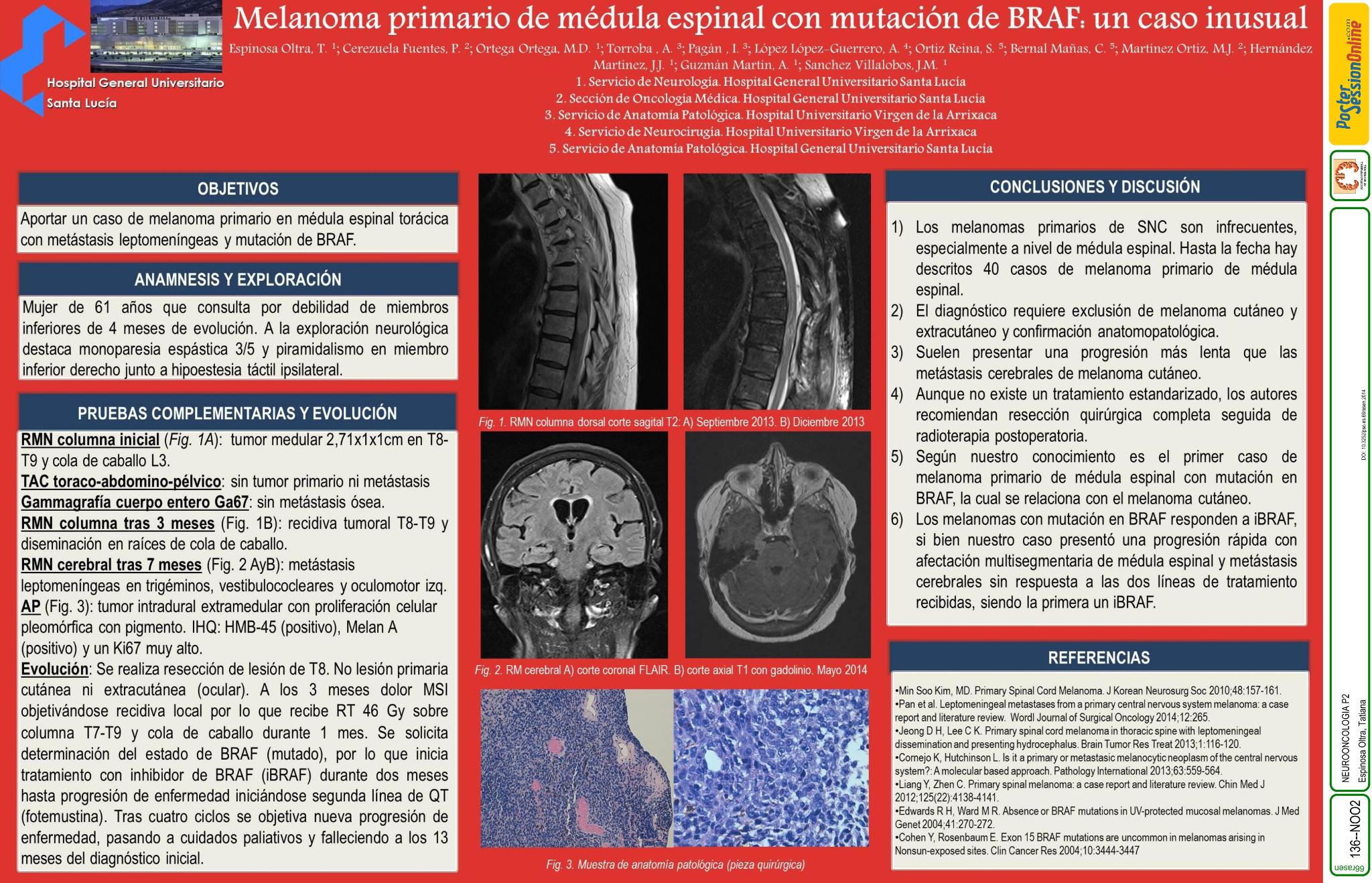 Melanoma primario de médula espinal con mutación de BRAF: un caso inusual