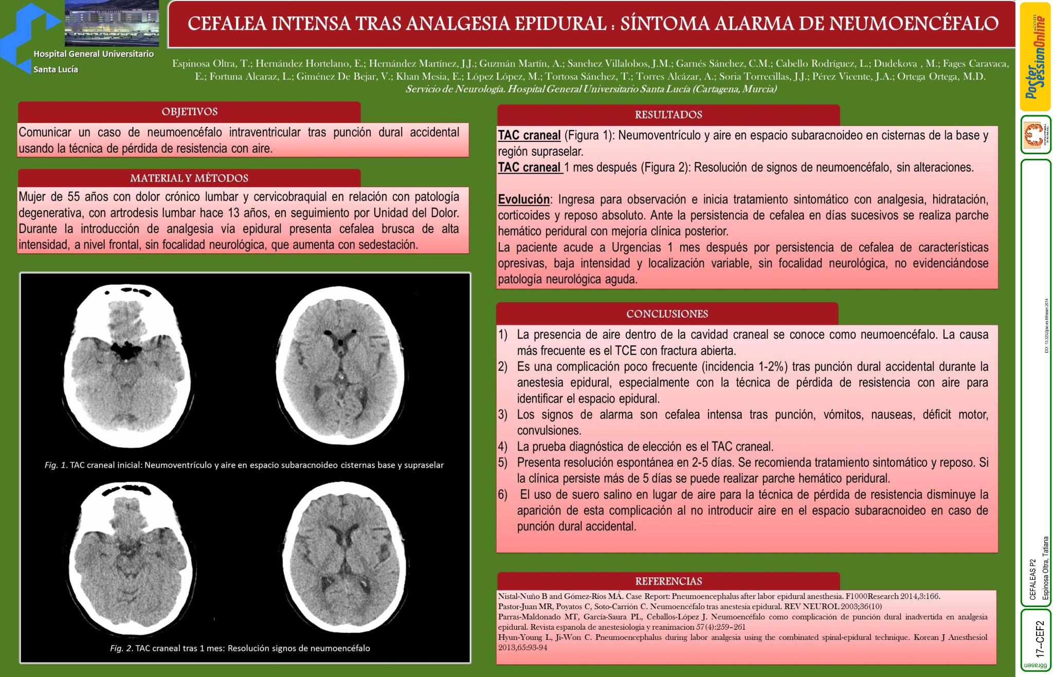 Cefalea intensa tras analgesia epidural: síntoma alarma de neumoencéfalo