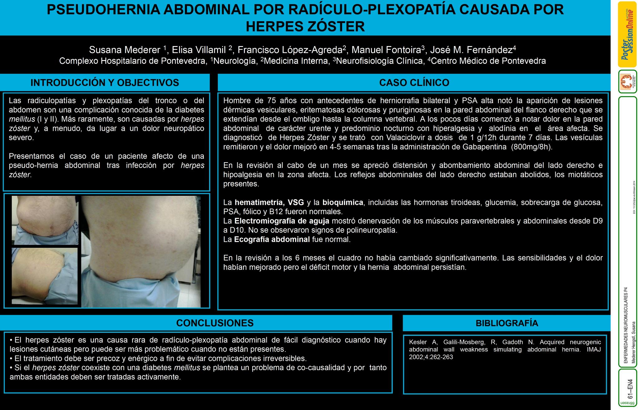 Pseudohernia abdominal  por radiculo-plexopatía causada por herpes zóster.