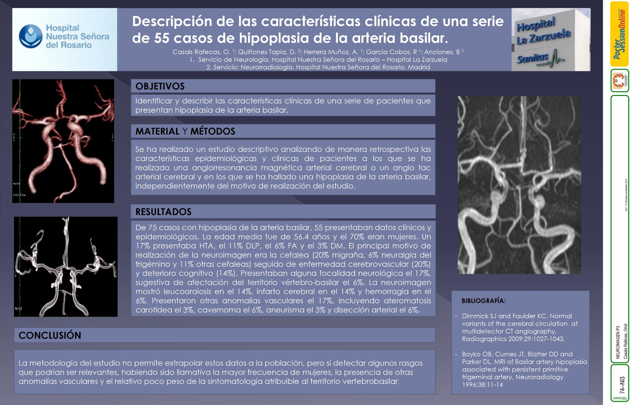 Descripción de las características clínicas de una serie de 55 casos de hipoplasia de la arteria basilar
