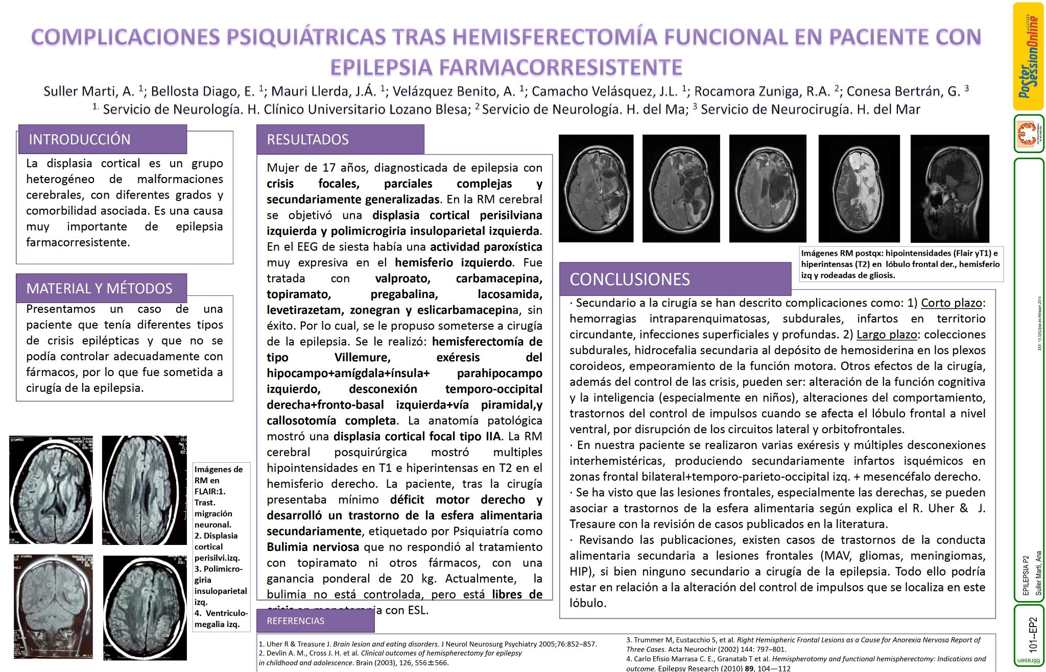 Complicaciones psiquiátricas tras hemisferectomía funcional en paciente con epilepsia farmacorresistente