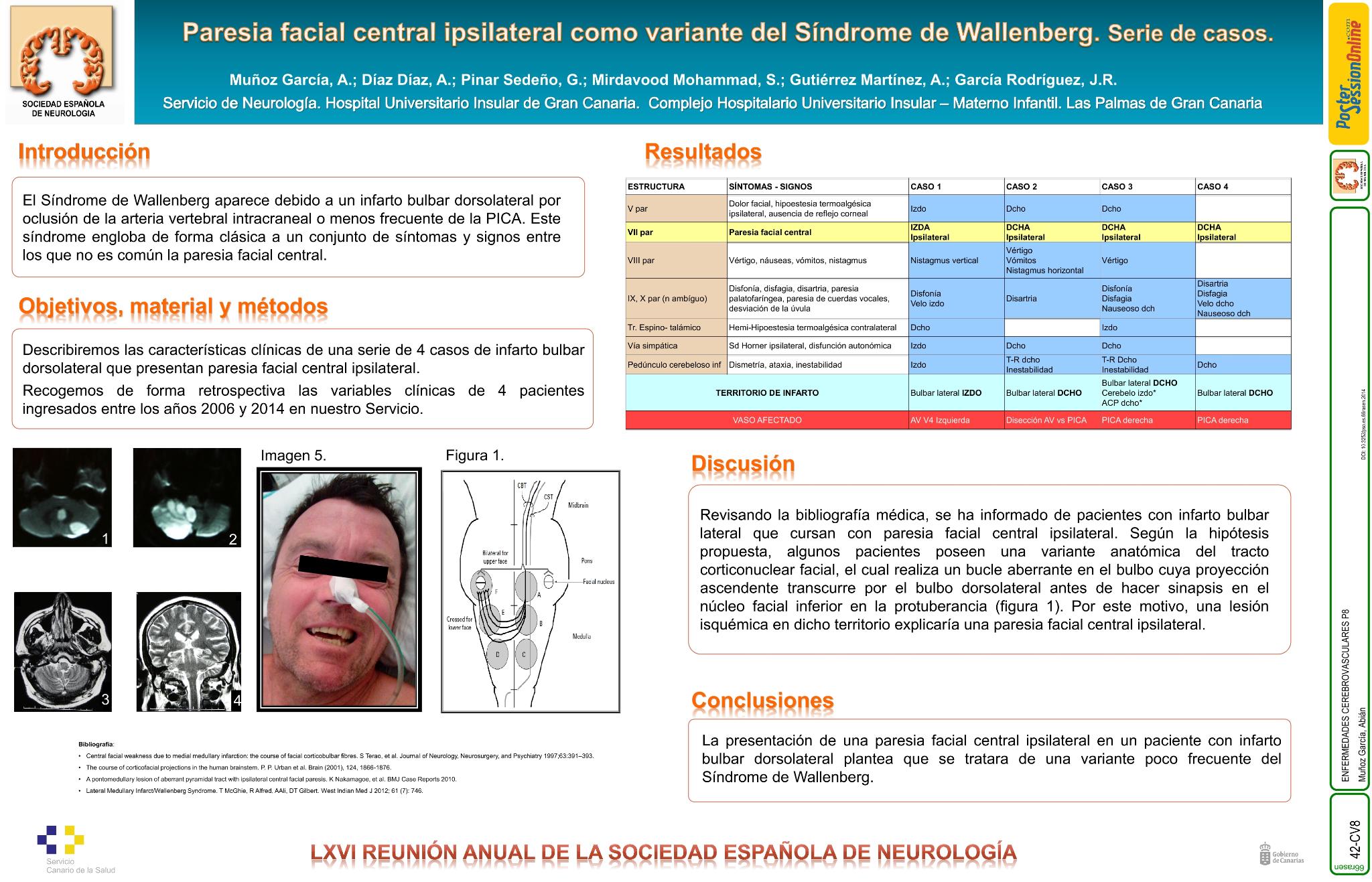 Paresia facial central ipsilateral como variante del Síndrome de Wallenberg. Serie de casos
