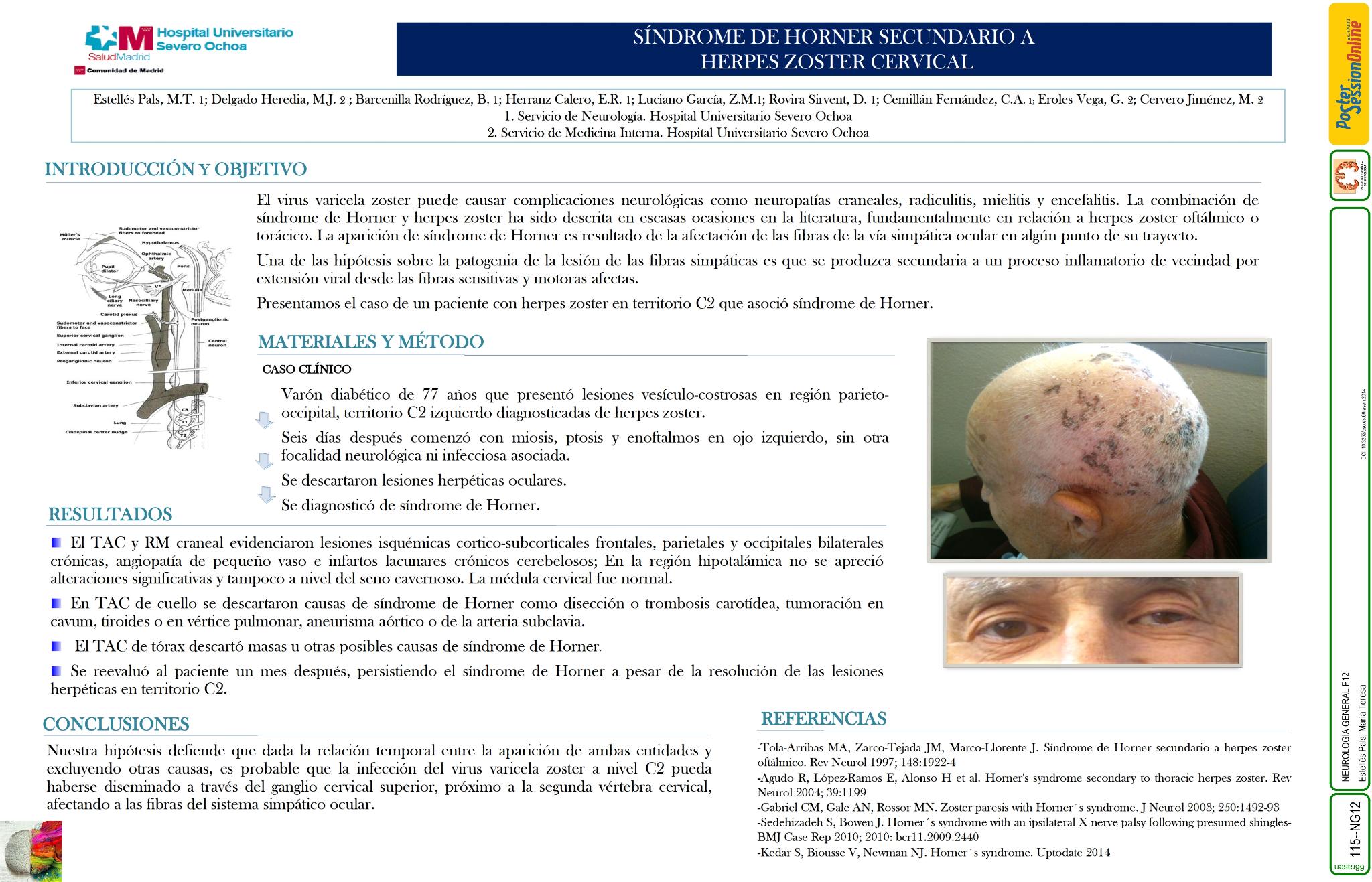 Síndrome de Horner secundario a virus herpes zoster cervical