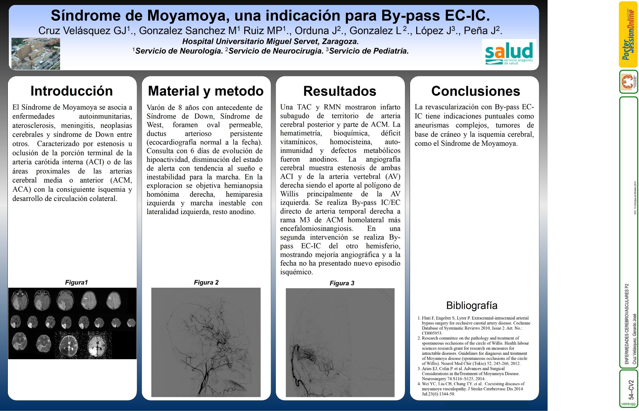 Síndrome de Moyamoya, una indicación de By-pass Extracraneal-Intracraneal (EC-IC)