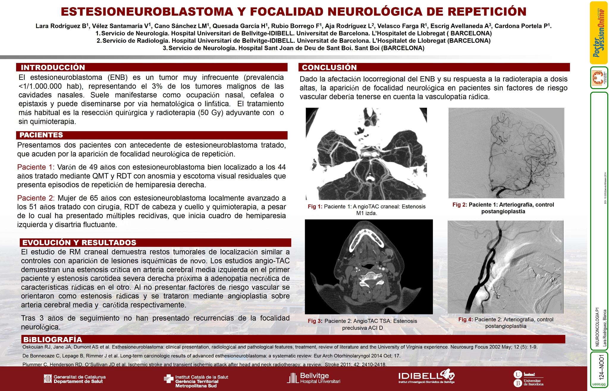 Estesioneuroblastoma y focalidad neurológica de repetición