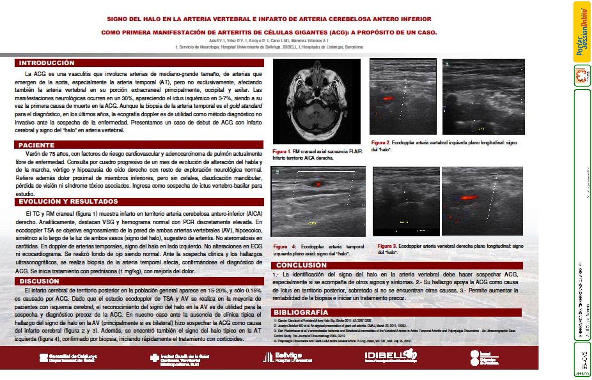 Signo del halo en la arteria vertebral e infarto de arteria cerebelosa antero inferior (AICA) como primera manifestación de arteritis de células gigantes (ACG): a propósito de un caso