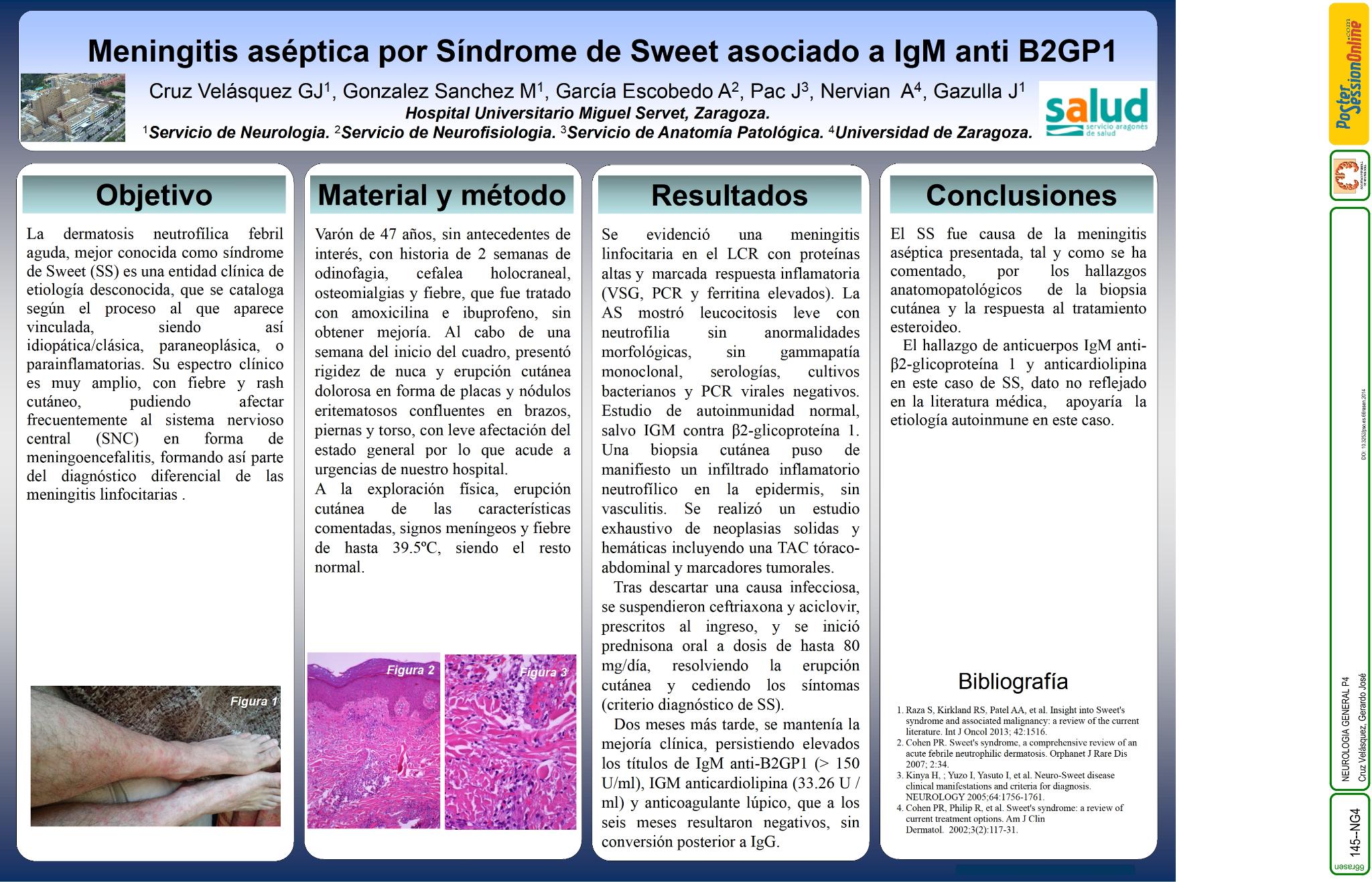 Síndrome de Sweet como causa de meningitis linfocitaria