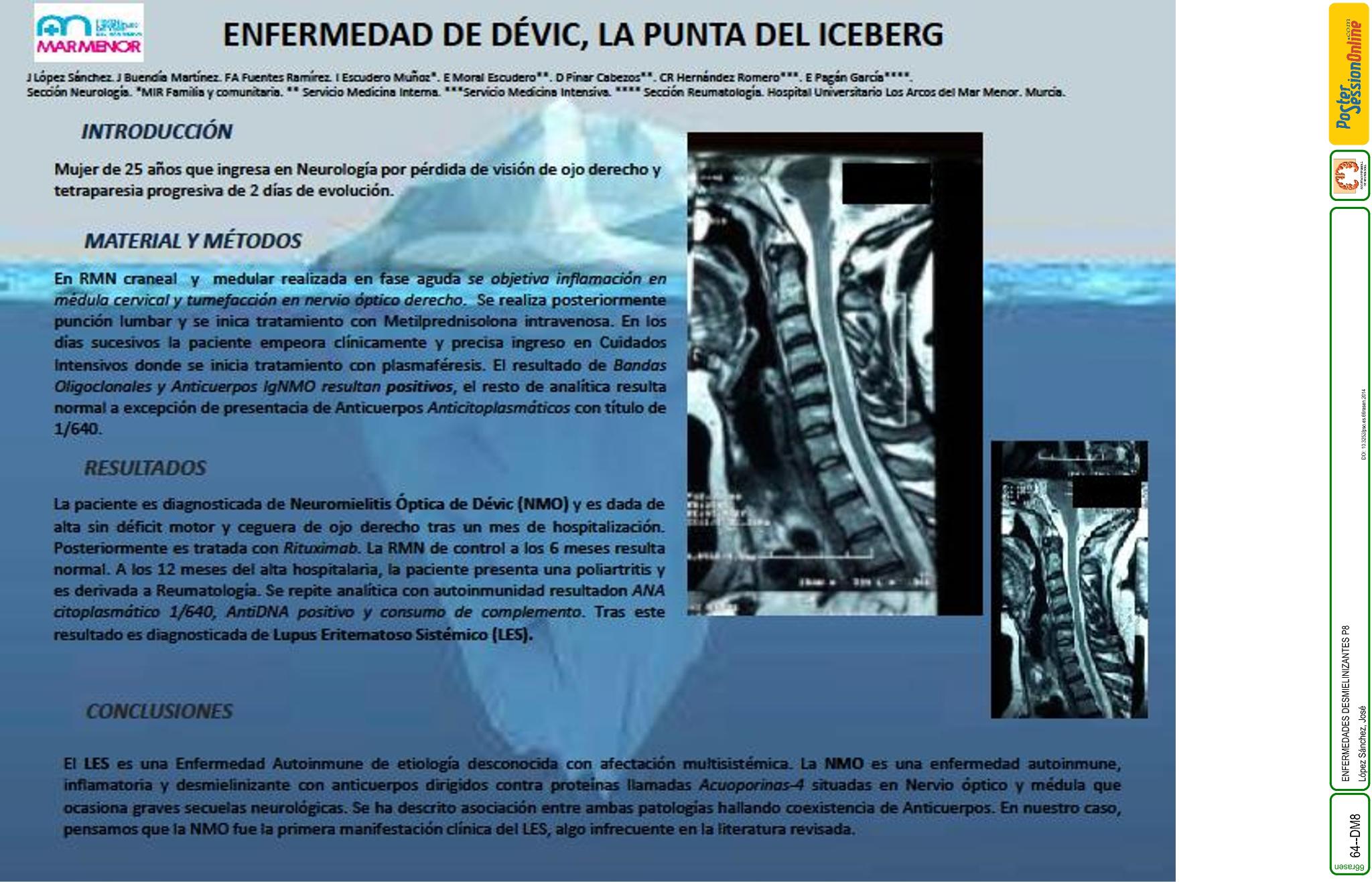 Enfermedad de Dévic. La punta del iceberg