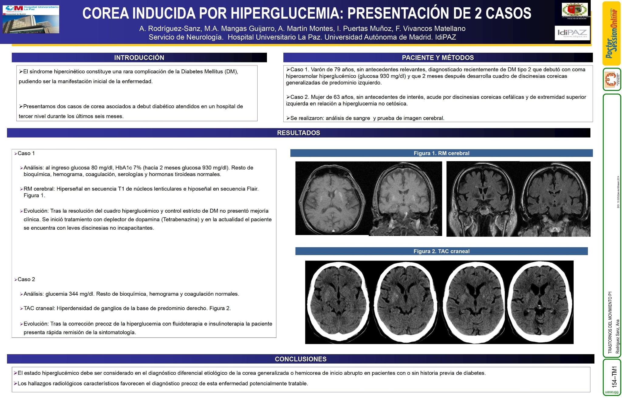 Corea inducida por hiperglucemia: presentación de 2 casos