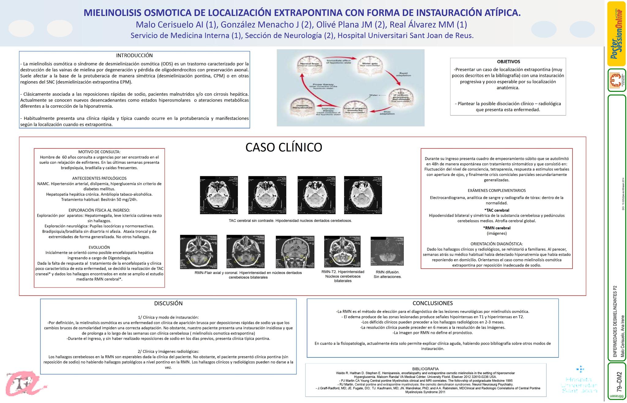 Mielinolisis extrapontina de lenta instauración