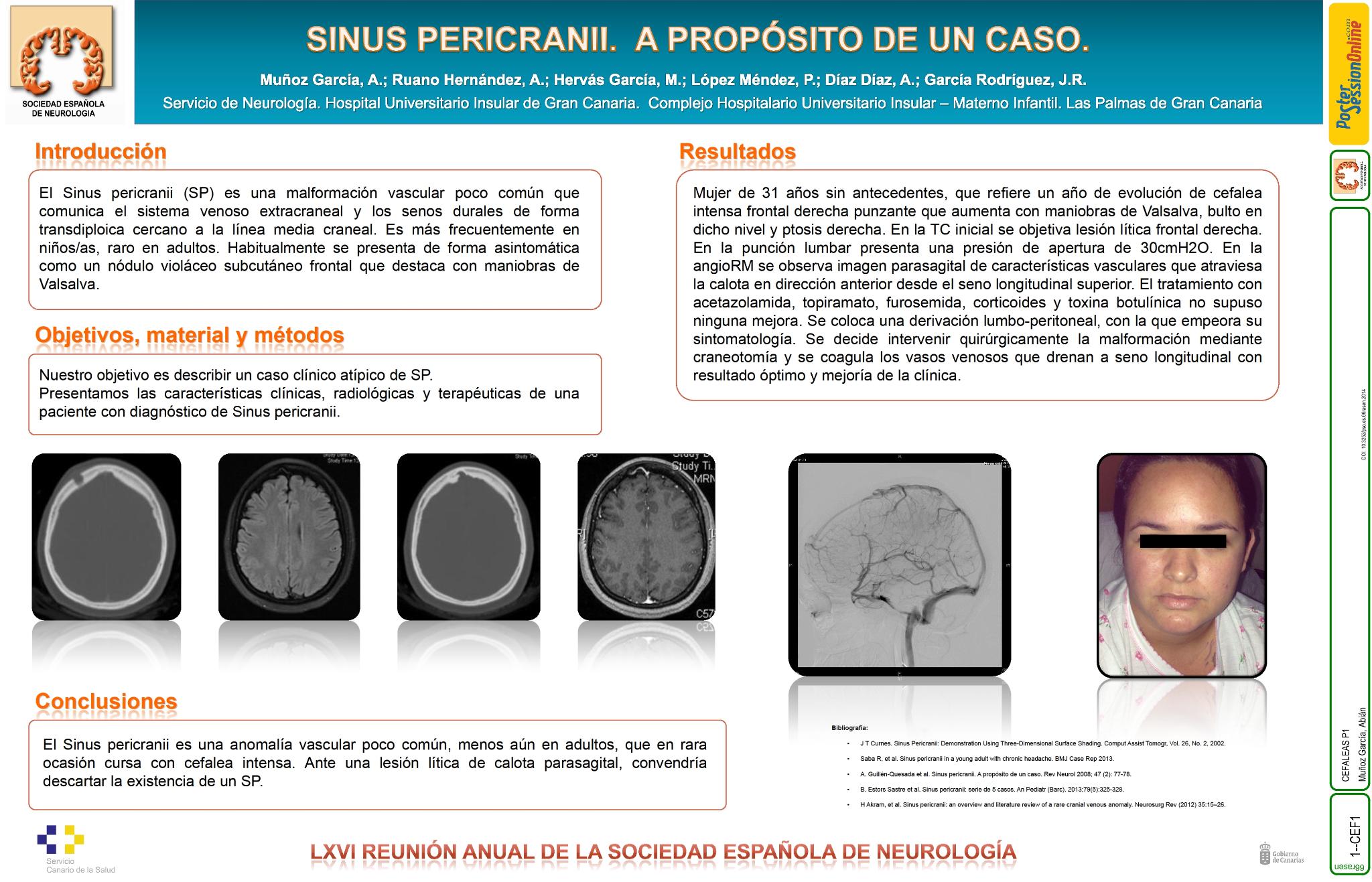 Sinus pericranii. A propósito de un caso