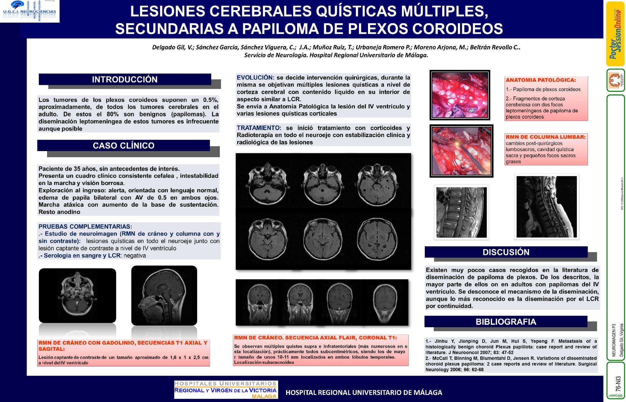 Lesiones cerebrales quísticas múltiples, secundarias a papiloma de plexos coroideos