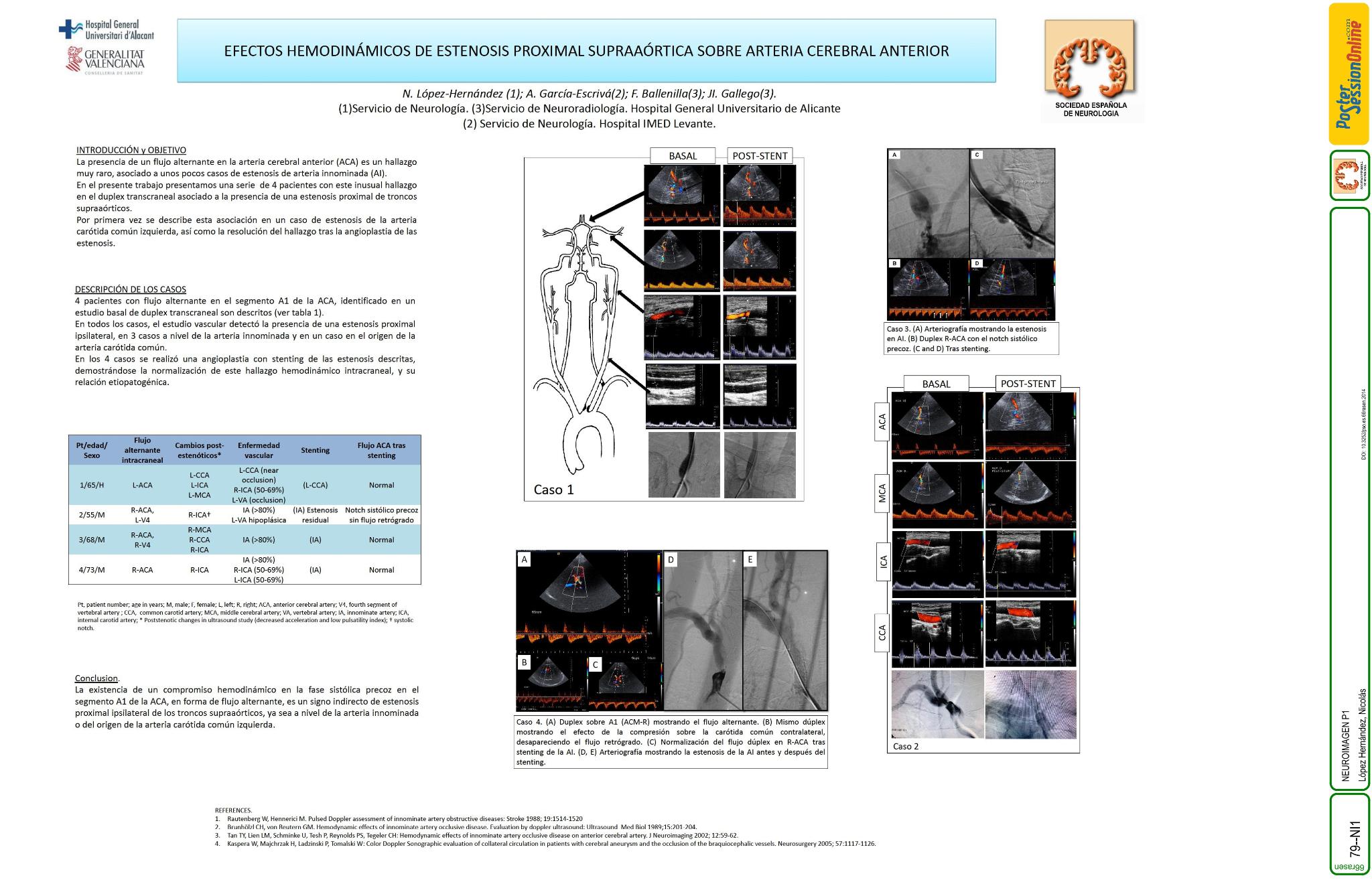 Flujo alternante en arteria cerebral anterior: efecto hemodinámico de estenosis proximales en troncos supraaórticos