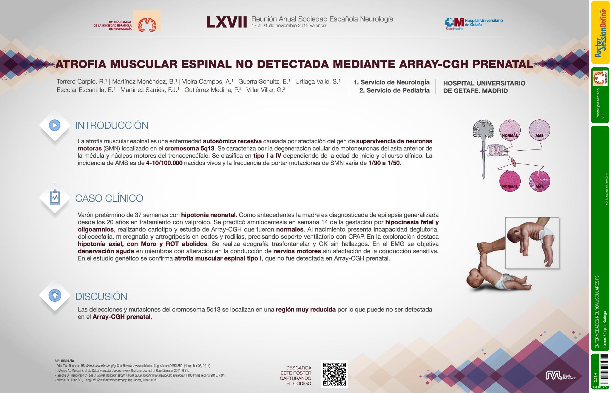 Atrofia muscular espinal no detectada mediante array-CGH prenatal