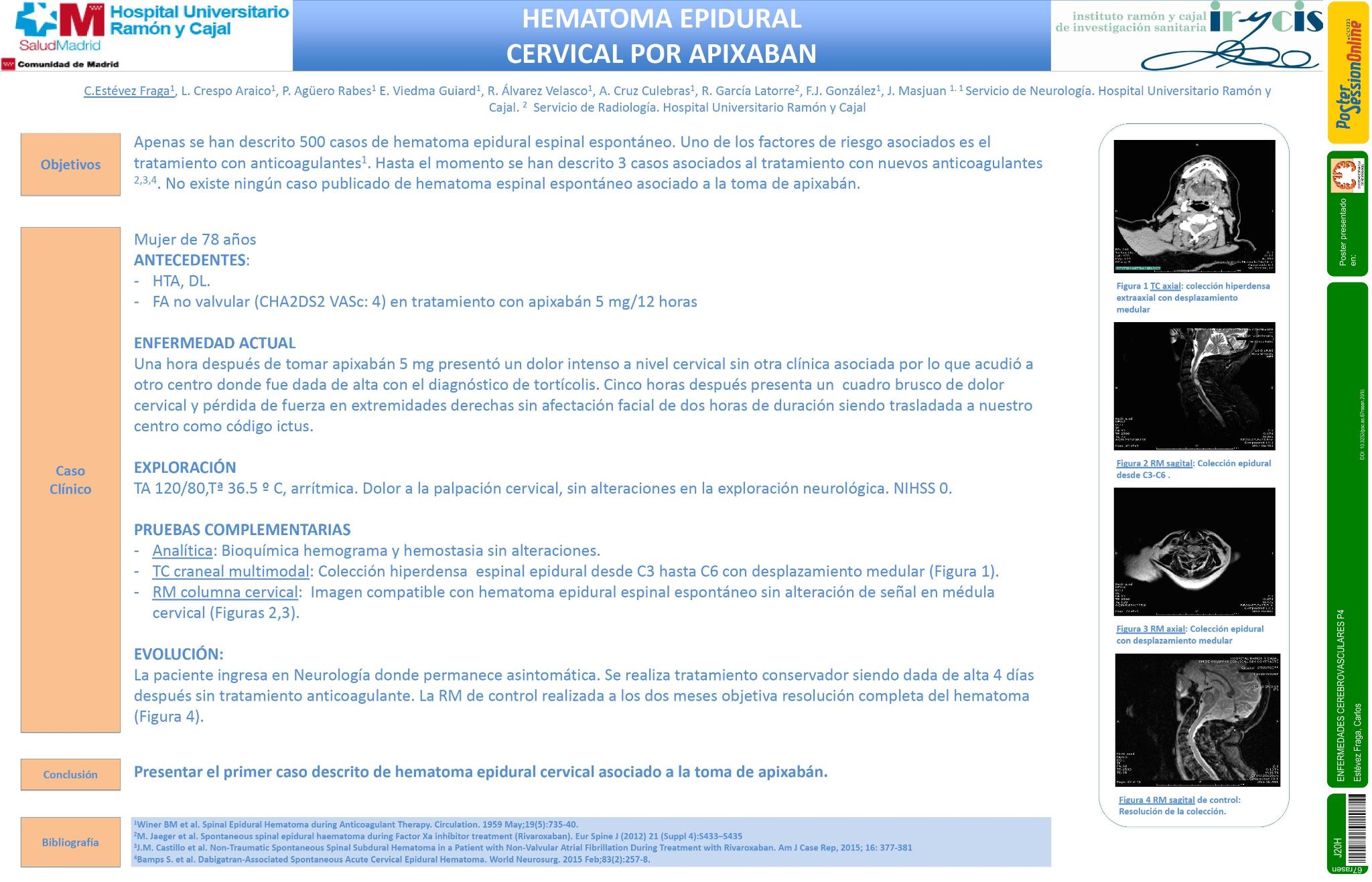 Hematoma epidural cervical por apixaban