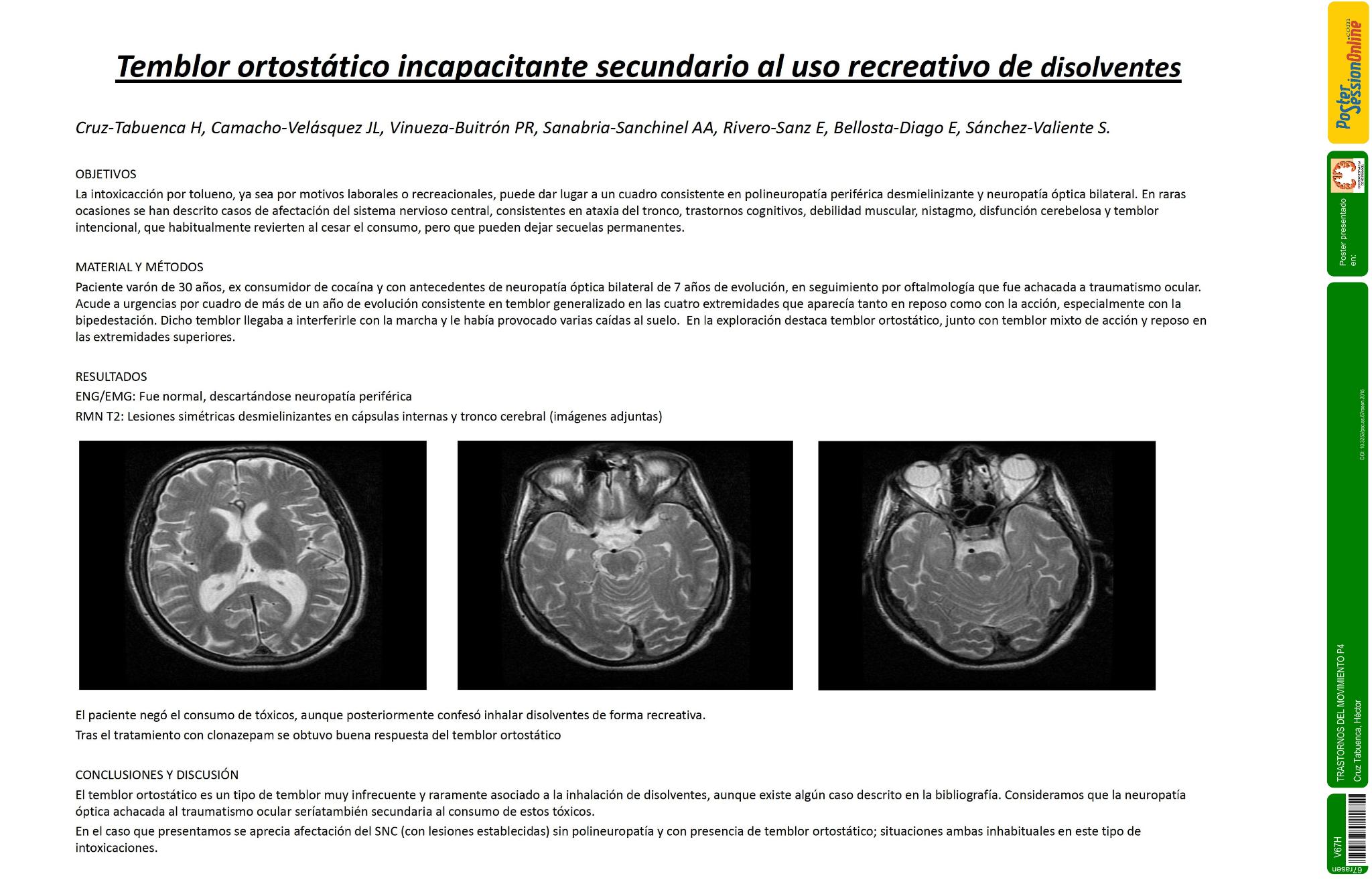 Temblor ortostático incapacitante secundario al uso recreativo de disolventes