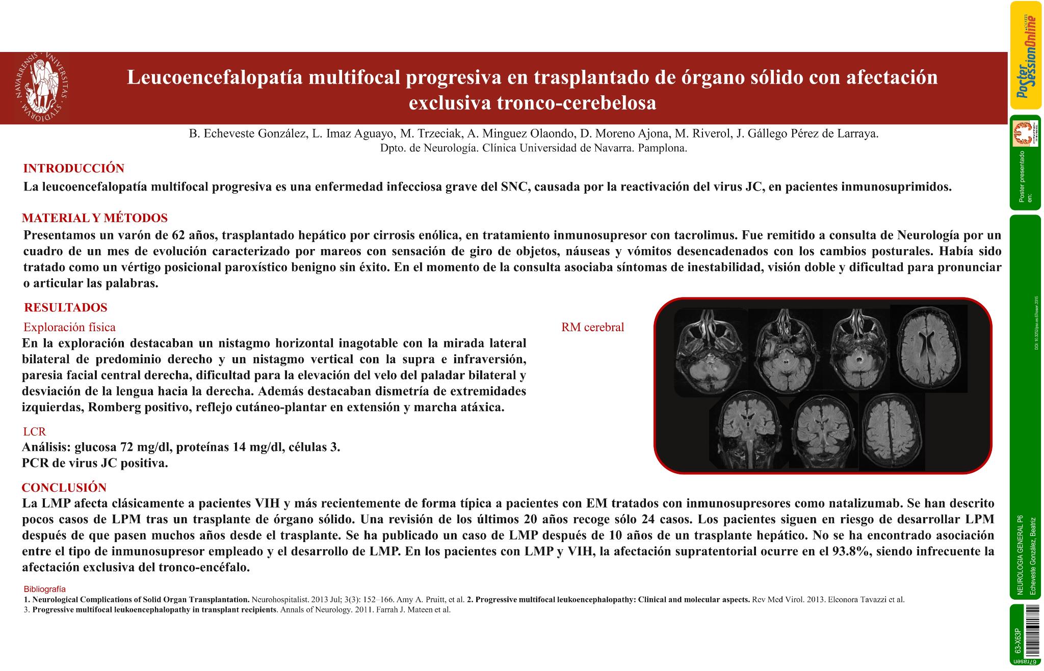 Leucoencefalopatía multifocal progresiva en trasplantado de órgano sólido con afectación exclusiva tronco-cerebelosa
