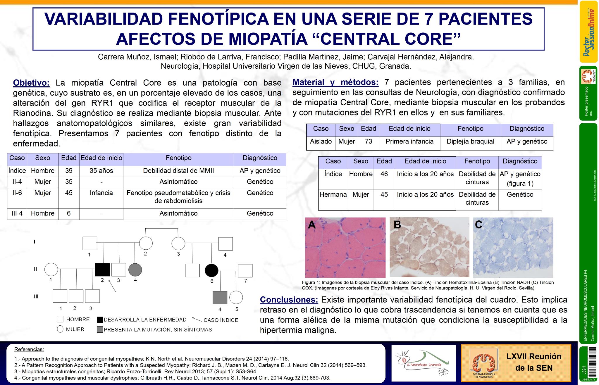 Variabilidad fenotípica en una serie de 7 pacientes afectos de Miopatía congénita “Central Core”