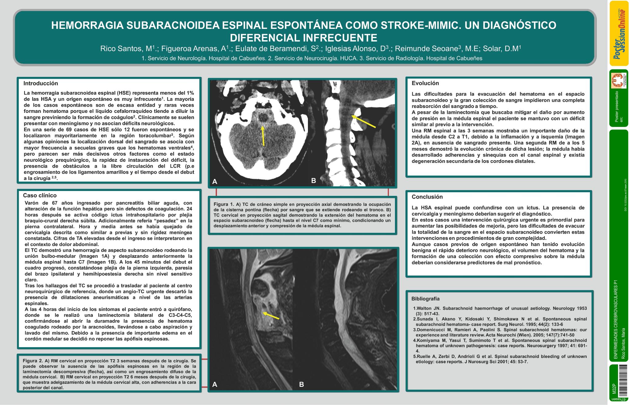 Hemorragia subaracnoidea espinal espontánea como stroke-mimic. Un diagnóstico diferencial infrecuente