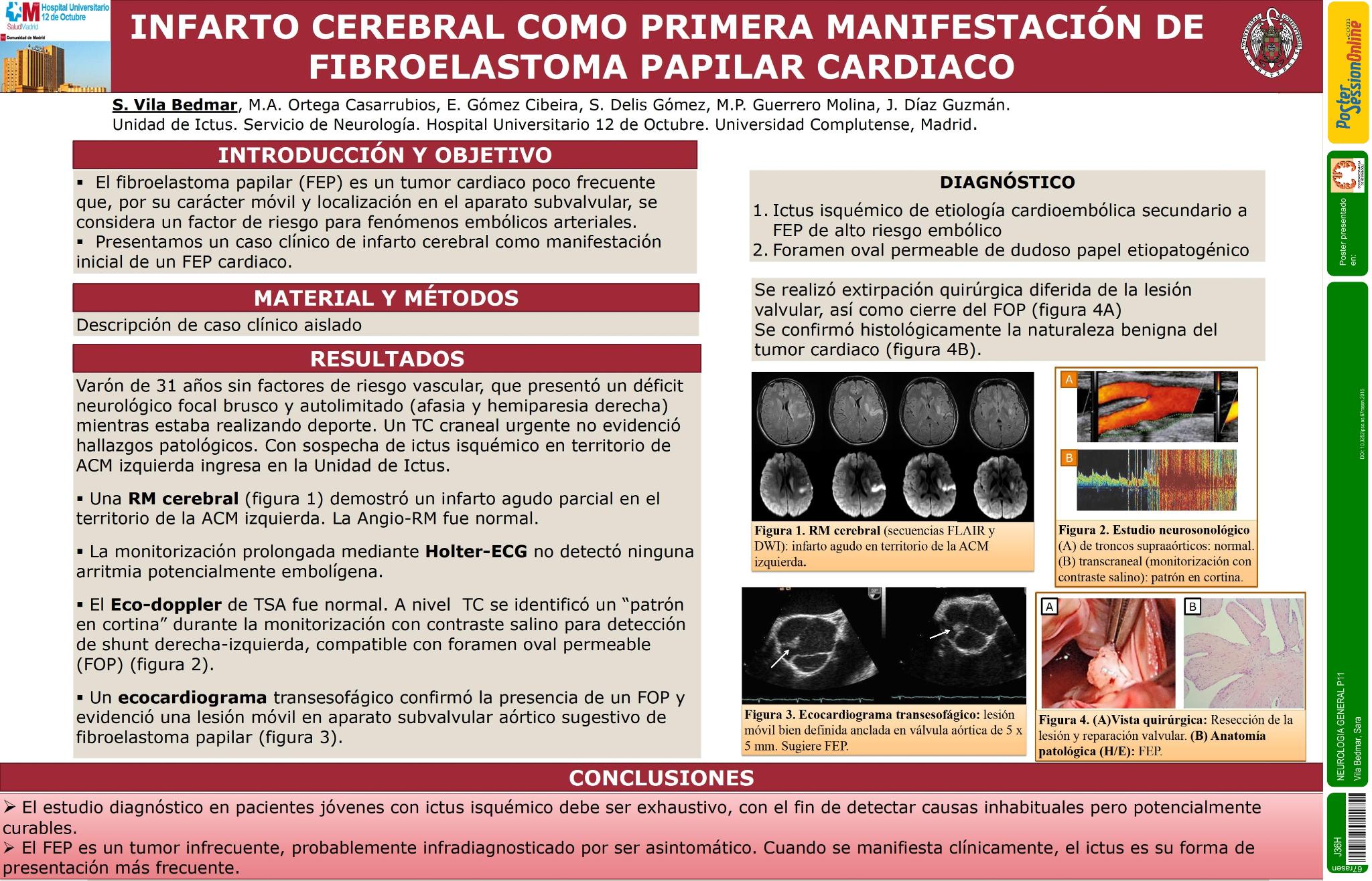 Infarto cerebral como primera manifestación de fibroelastoma papilar cardiaco