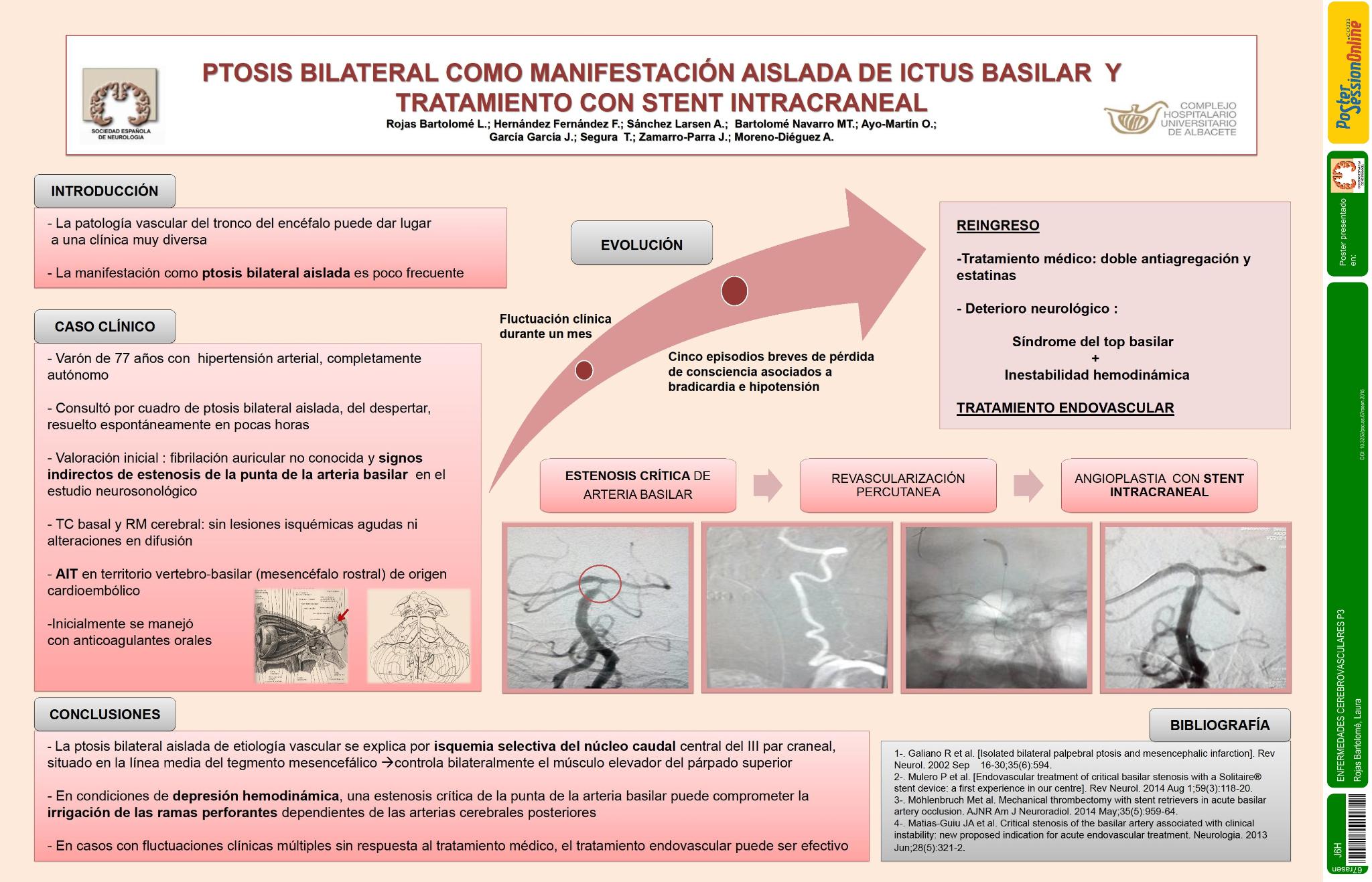 Ptosis bilateral como manifestación aislada de ictus basilar y tratamiento con stent intracraneal